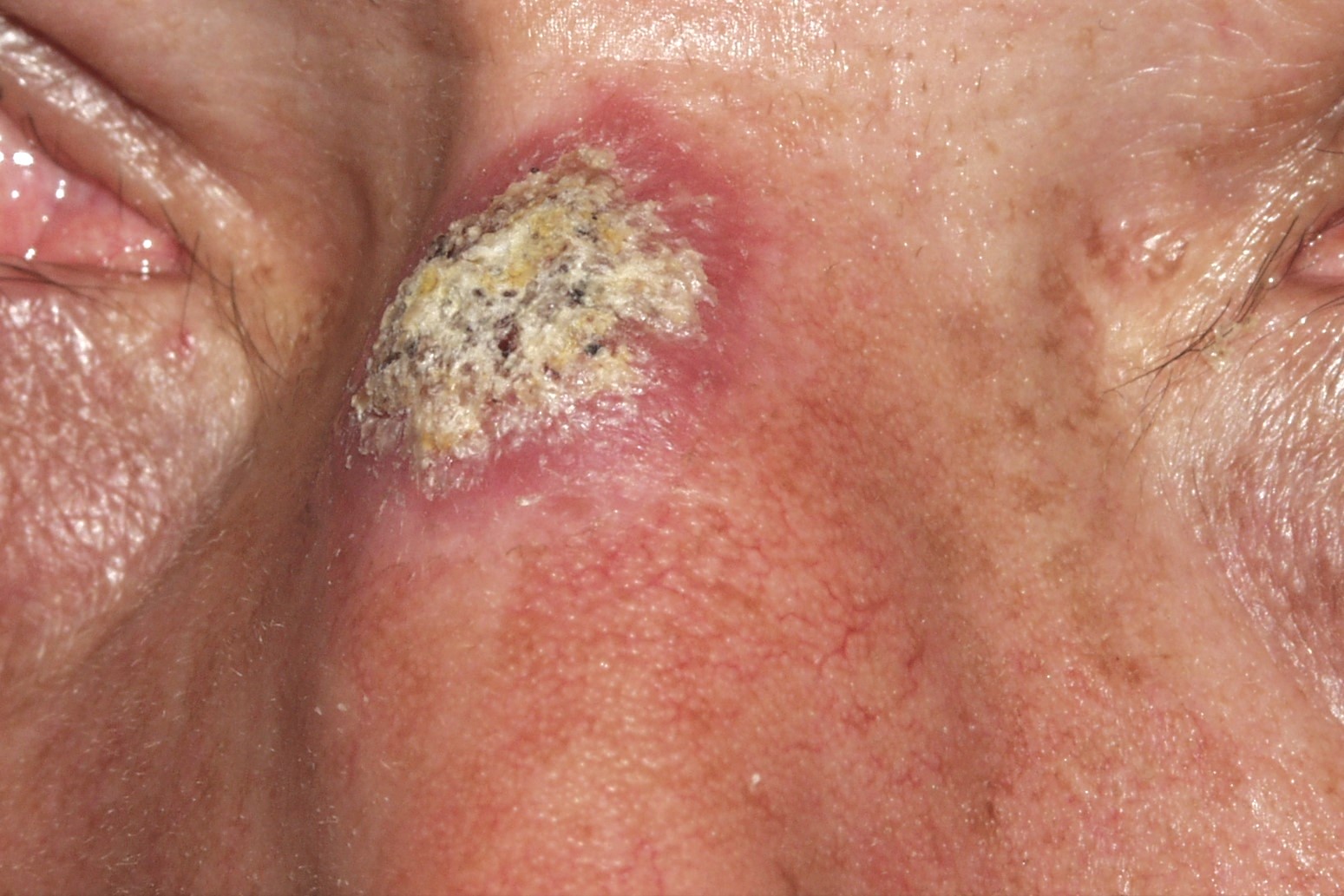 Leishmaniasis cutánea B55.1; boton de oriente, papulonódulo eritematoescamoso, de 4 meses de evolución en dorso nasal (1)