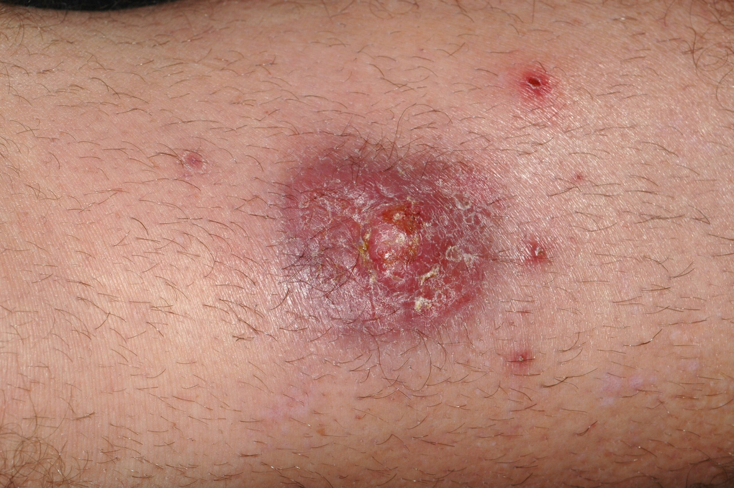 Leishmaniasis cutánea B55.1; boton de oriente. Nódulo eritematodescamativo, de 6 meses de evolución en sien izquierda y de consistencia blanda (2)