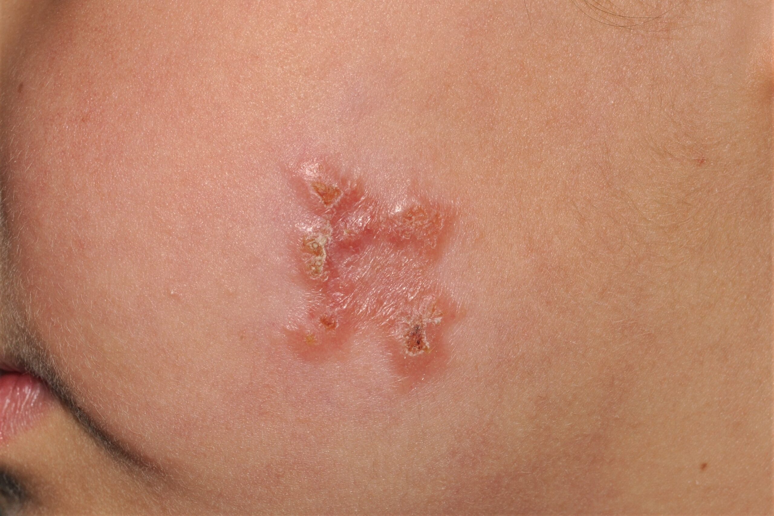 Leishmaniasis recidivans B55.1, Boton de oriente; placa eritematosa, anaranjada de superficie irregular y centro deprimido