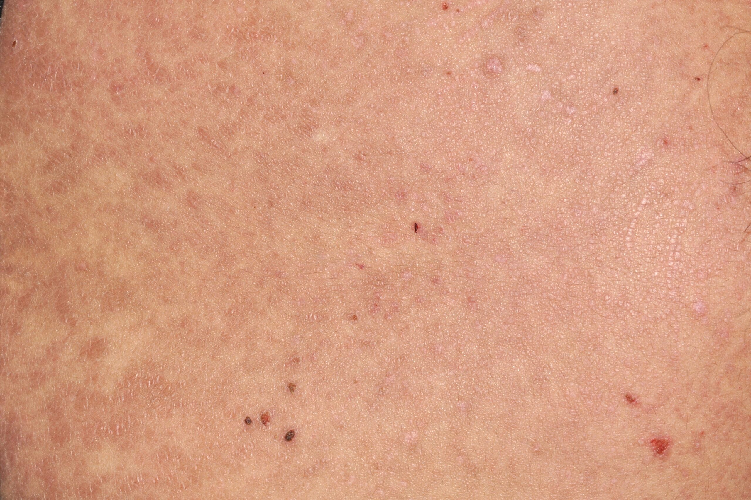 Liquen plano-Penfigoide L43.8; p&aacute;pulas liquenoides extensas junto con erosiones y costras en parte superior de espalda