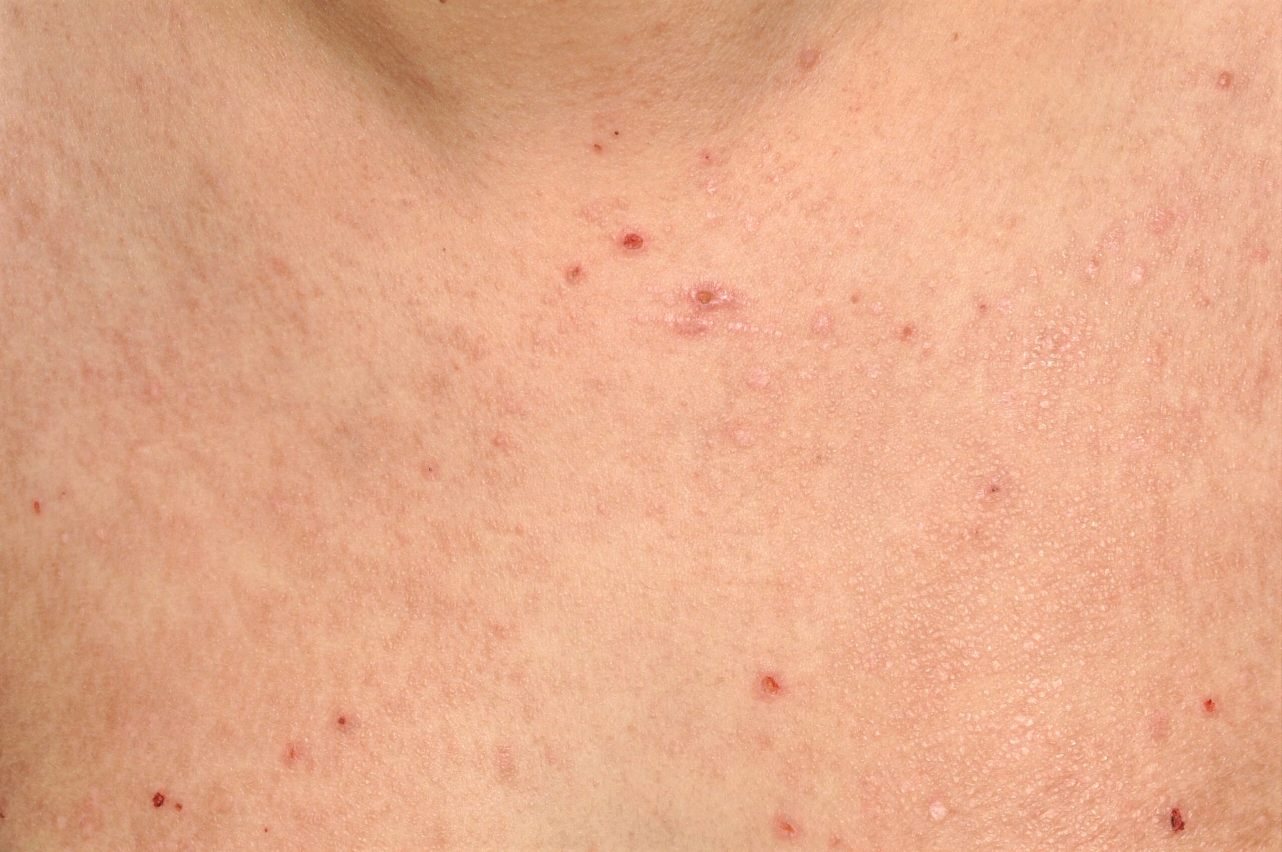 Liquen plano-Penfigoide L43.8; p&aacute;pulas liquenoides extensas junto con ves&iacute;culas, erosiones y costras en escote