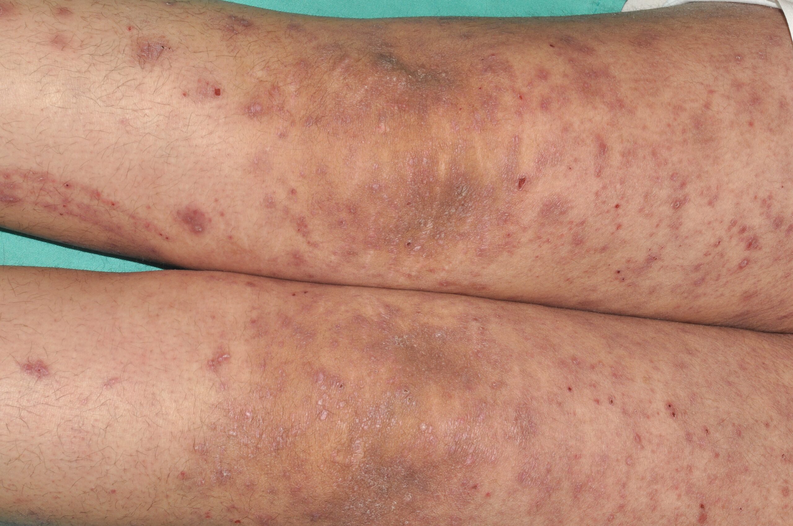 Liquen plano-Penfigoide L43.8; p&aacute;pulas liquenoides extensas junto con ves&iacute;culas y costras en parte posterior de las piernas