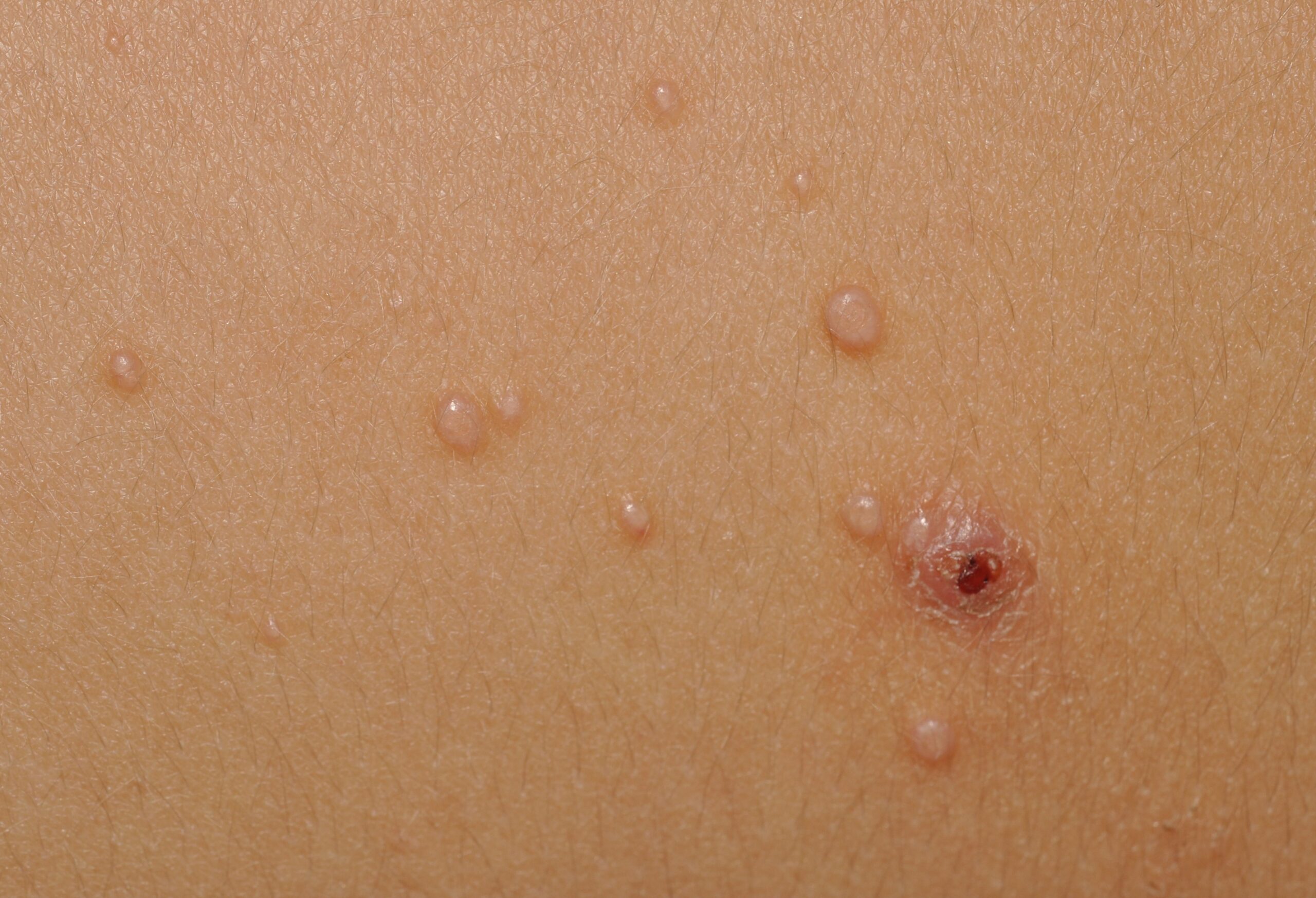 Molluscum contagiosum B08.1; pápulas lisas del color normal de la piel agrupadas en la zona lumbar
