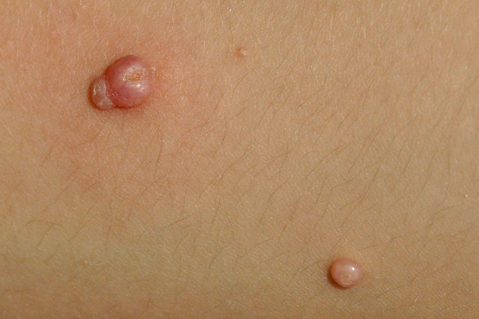 Molluscum contagiosum B08.1; pápulas lisas del color normal de la piel con umbilicación central; localización tronco