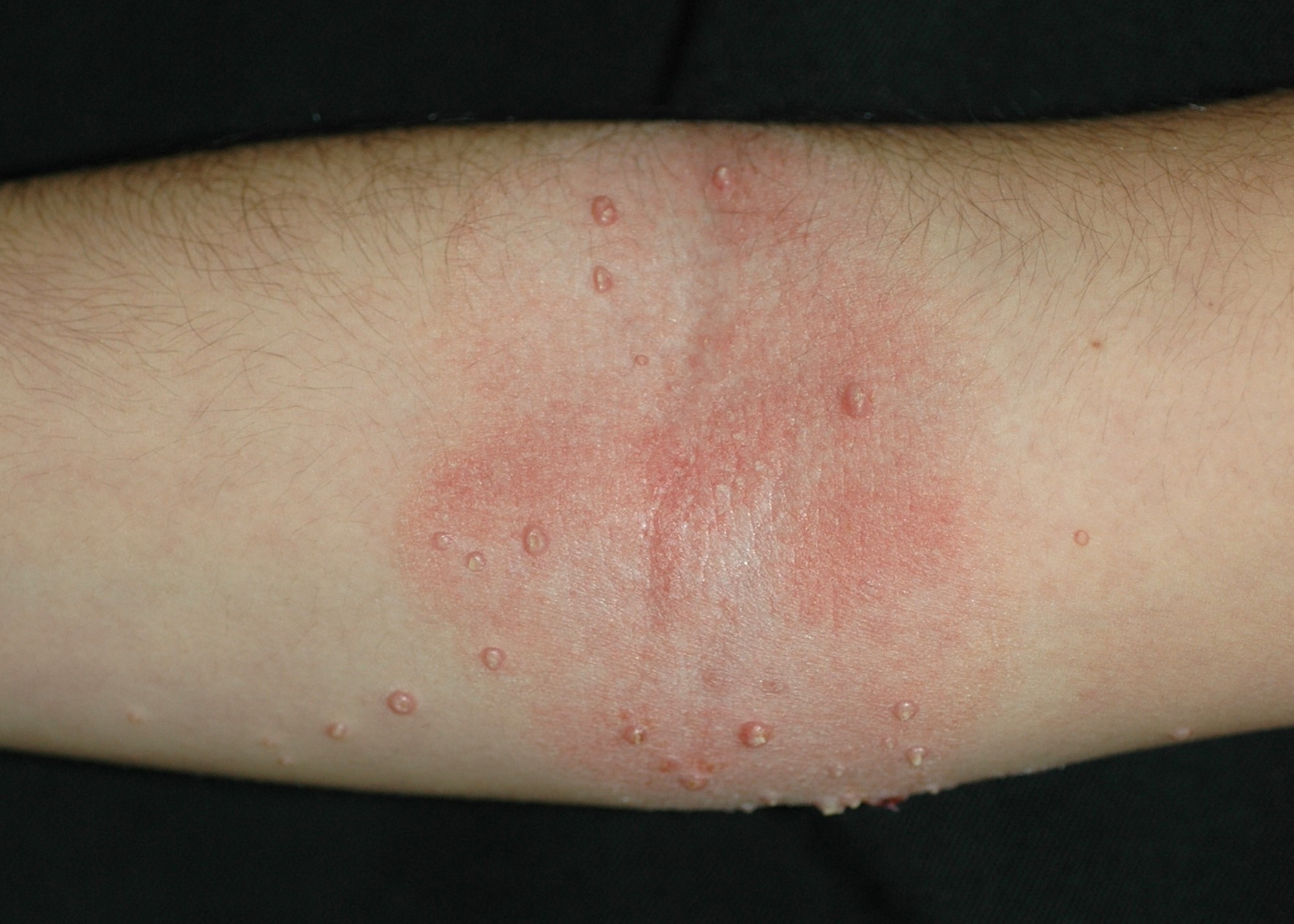 Molluscum contagiosum B08.1; pápulas lisas del color normal de la piel con umbilicación central sobre placa de dermatitis atópica