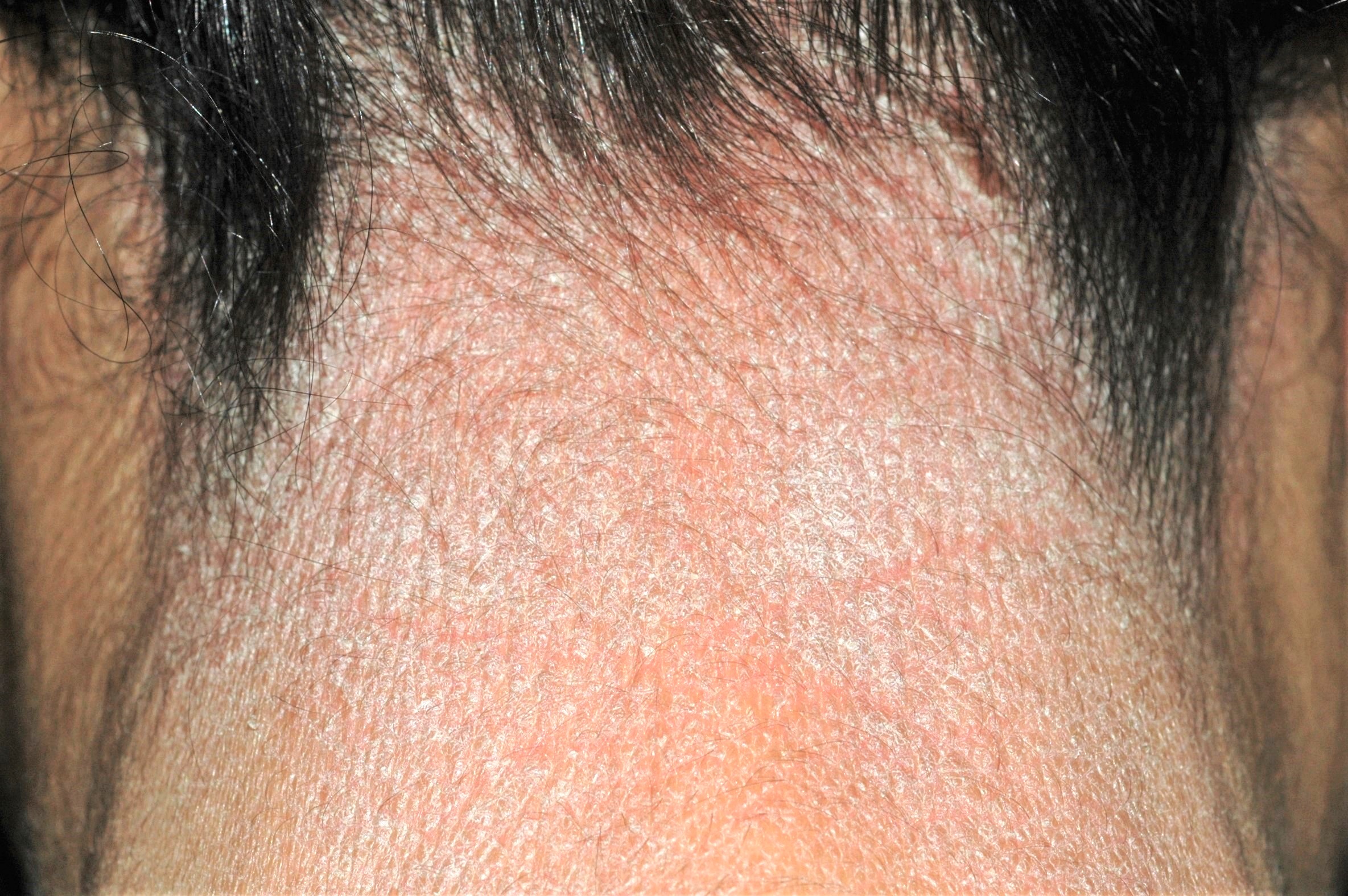 Neurodermitis L28.0; liquen simple cronico; placa eritematodescamativa y liquenificada en cuero cabelludo. Prurito crónico e incoercible (2)
