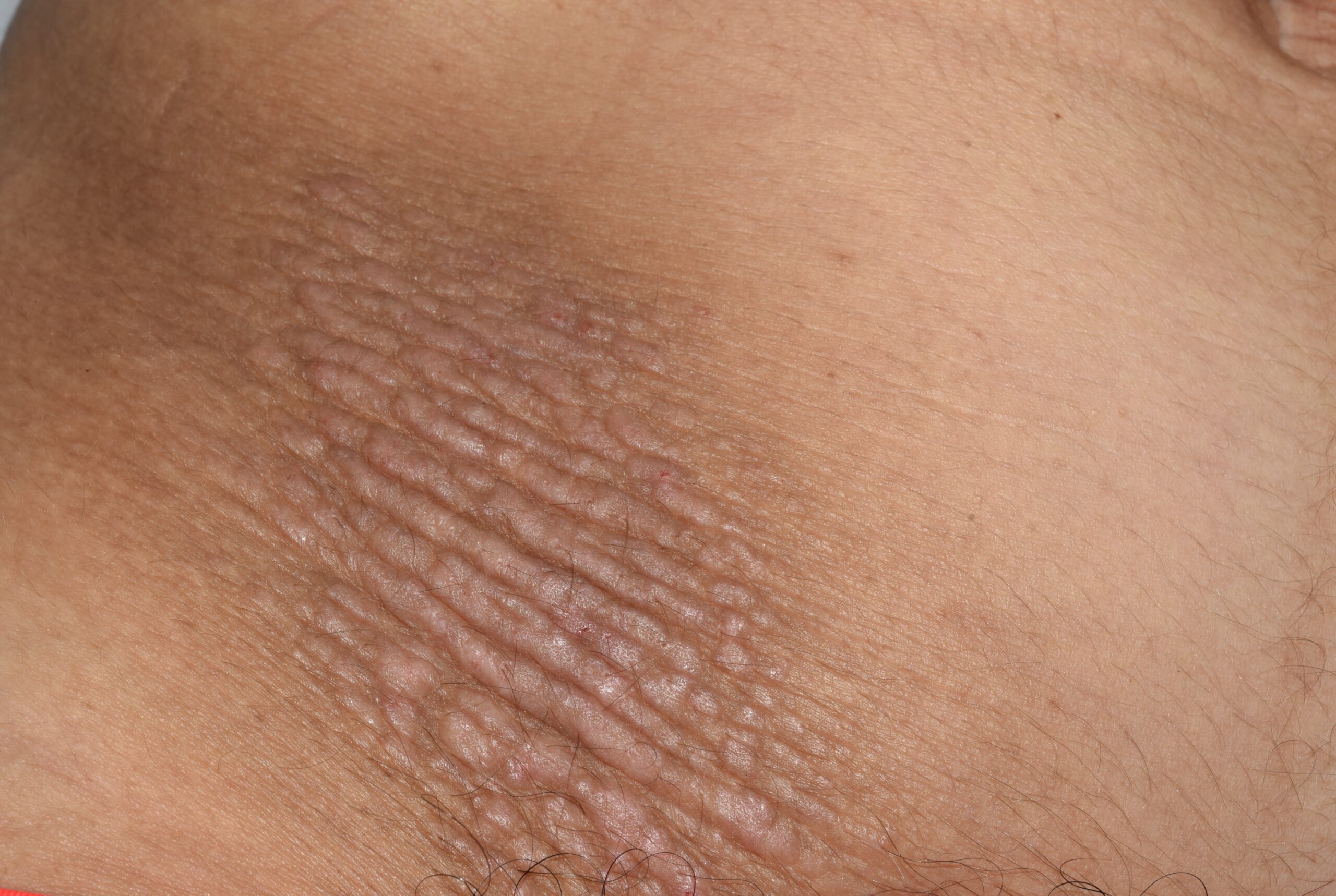 Neurodermitis L28.0; liquen simple cronico; placa eritematodescamativa y liquenificada en fosa ilíaca derecha. Prurito paroxístico (4)