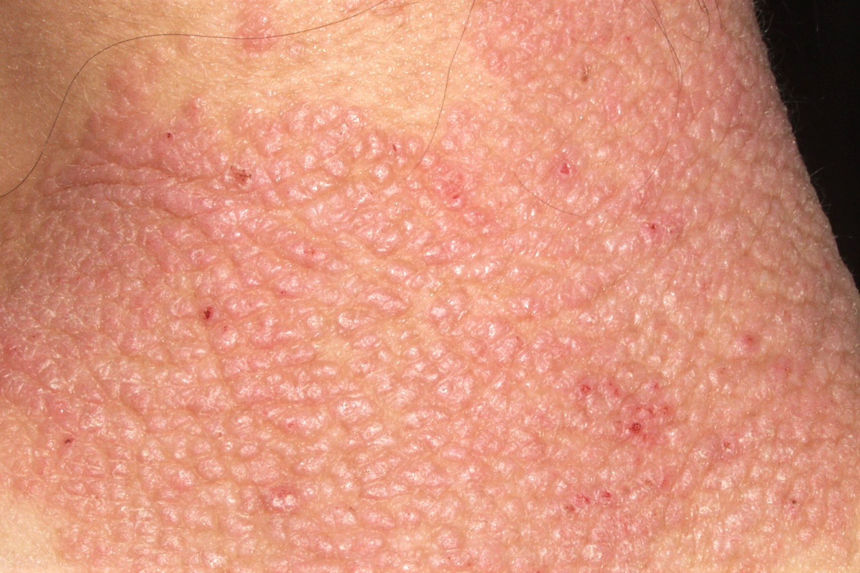 Neurodermitis L28.0; liquen simple cronico; placa eritematodescamativa y liquenificada en la nuca. Prurito crónico e incoercible (2)