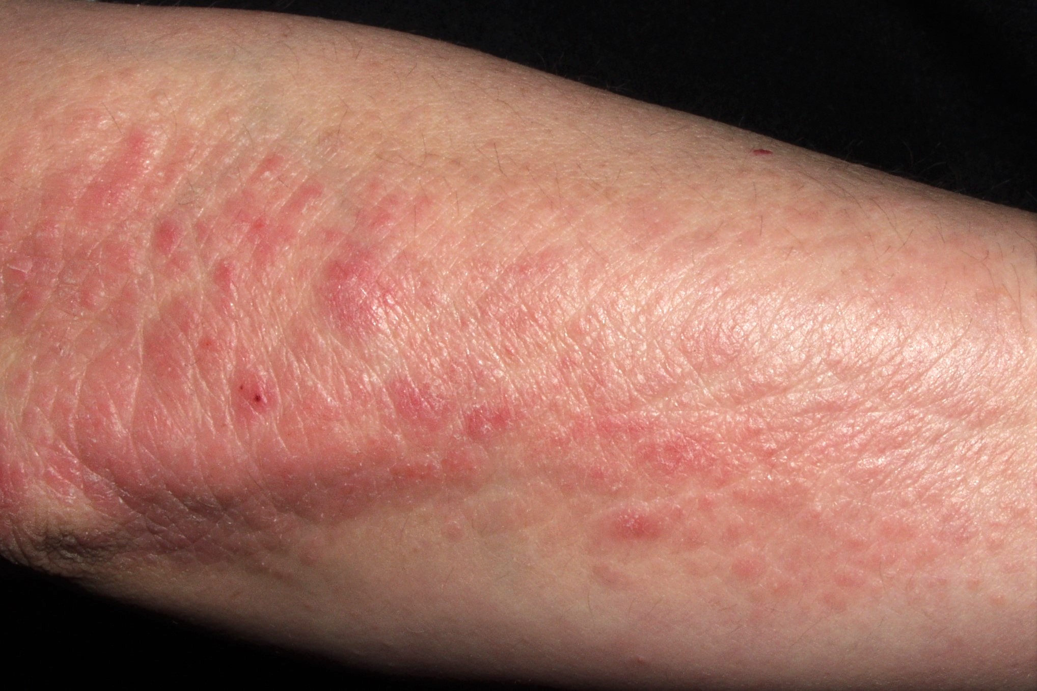 Neurodermitis L28.0; liquen simple cronico; placa eritematodescamativa y liquenificada pretibial. Prurito paroxístico (2)