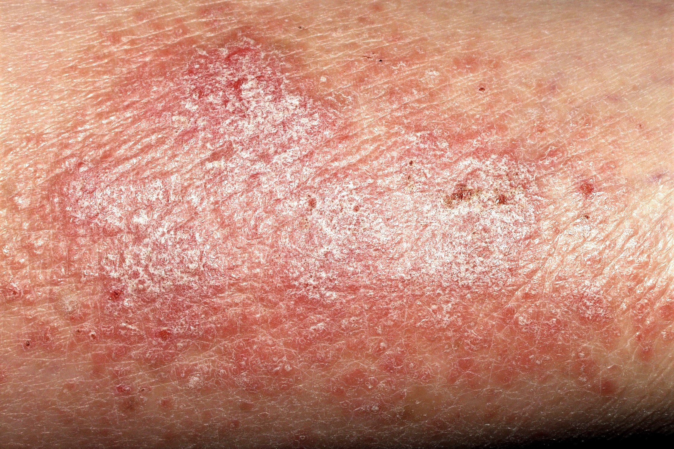 Neurodermitis L28.0; liquen simple cronico; placa eritematodescamativa y liquenificada pretibial. Prurito paroxístico (8)