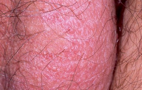 Neurodermitis escrotal L28.0; liquen simple cronico; placa eritematodescamativa y liquenificada. Prurito paroxístico