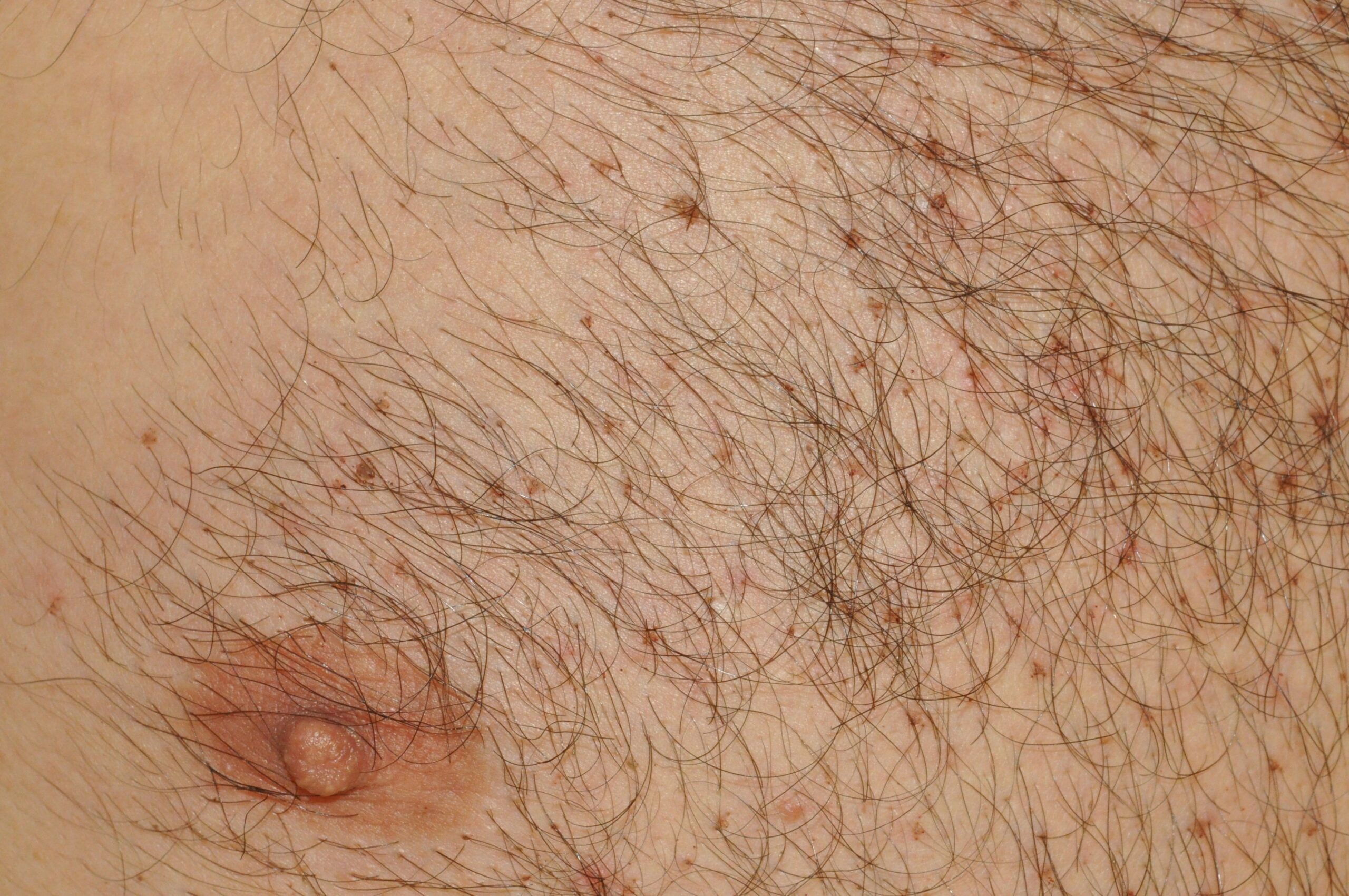Pediculosis corporis B85; pthirus y liendres en el pelo del pecho