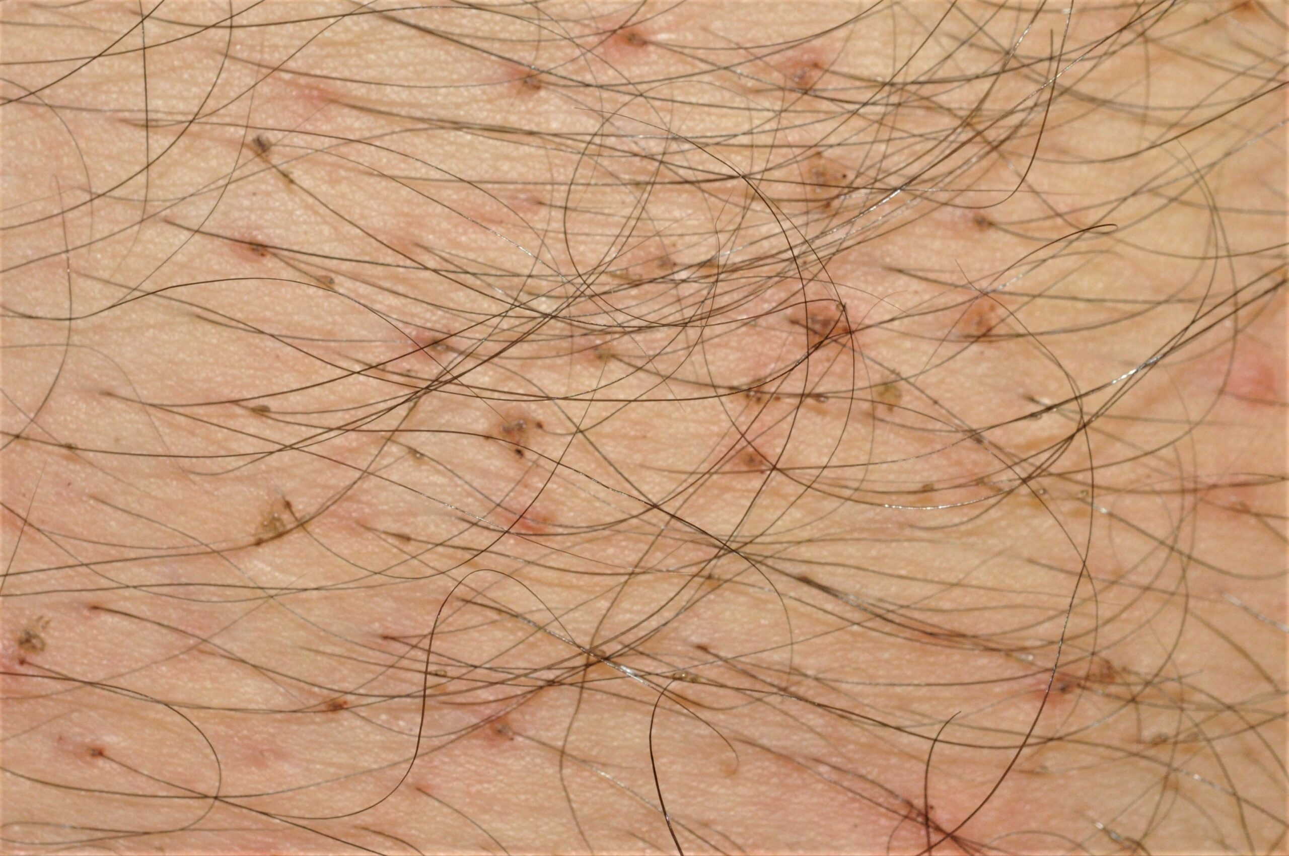 Pediculosis corporis B85; pthirus y liendres en el pelo del pecho; se observan los parasitos triangulares adheridos con sus patas al vello corporal