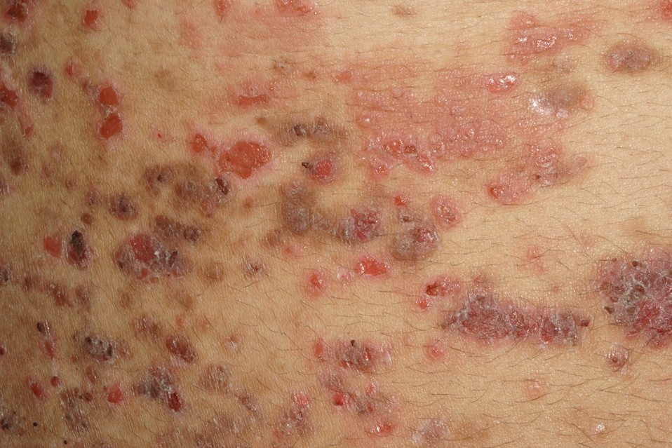 P&eacute;nfigo foli&aacute;ceo L10; fogo selvagem, ampollas fl&aacute;cidas y costras en la espalda de evoluci&oacute;n cr&oacute;nica