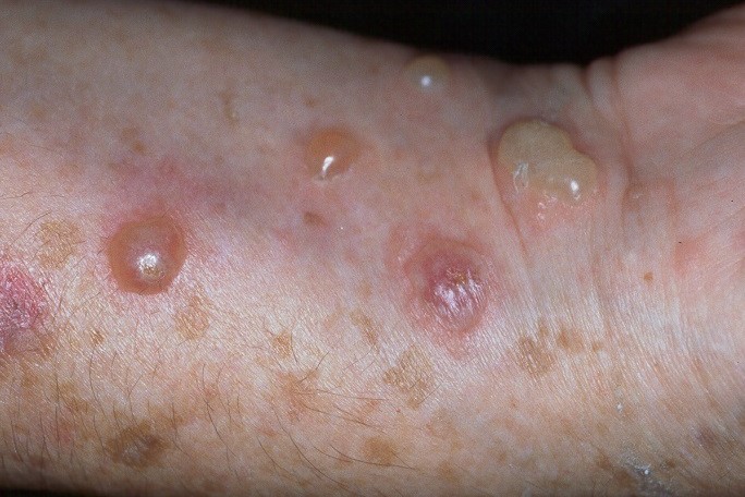 Penfigo vulgar L10; ampollas flaccidas y a tensi&oacute;n en cara anterior del brazo