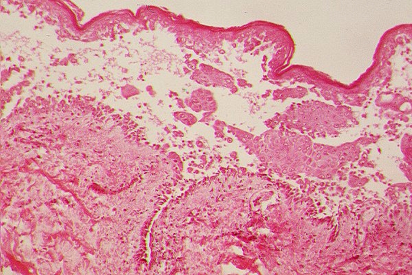 P&eacute;nfigo vulgar, estudio histol&oacute;gico L10; ampolla intraepid&eacute;rmica, por hendidura suprabasal con acant&oacute;lisis. Queratinocitos basales en l&aacute;pida de cementerio (1)