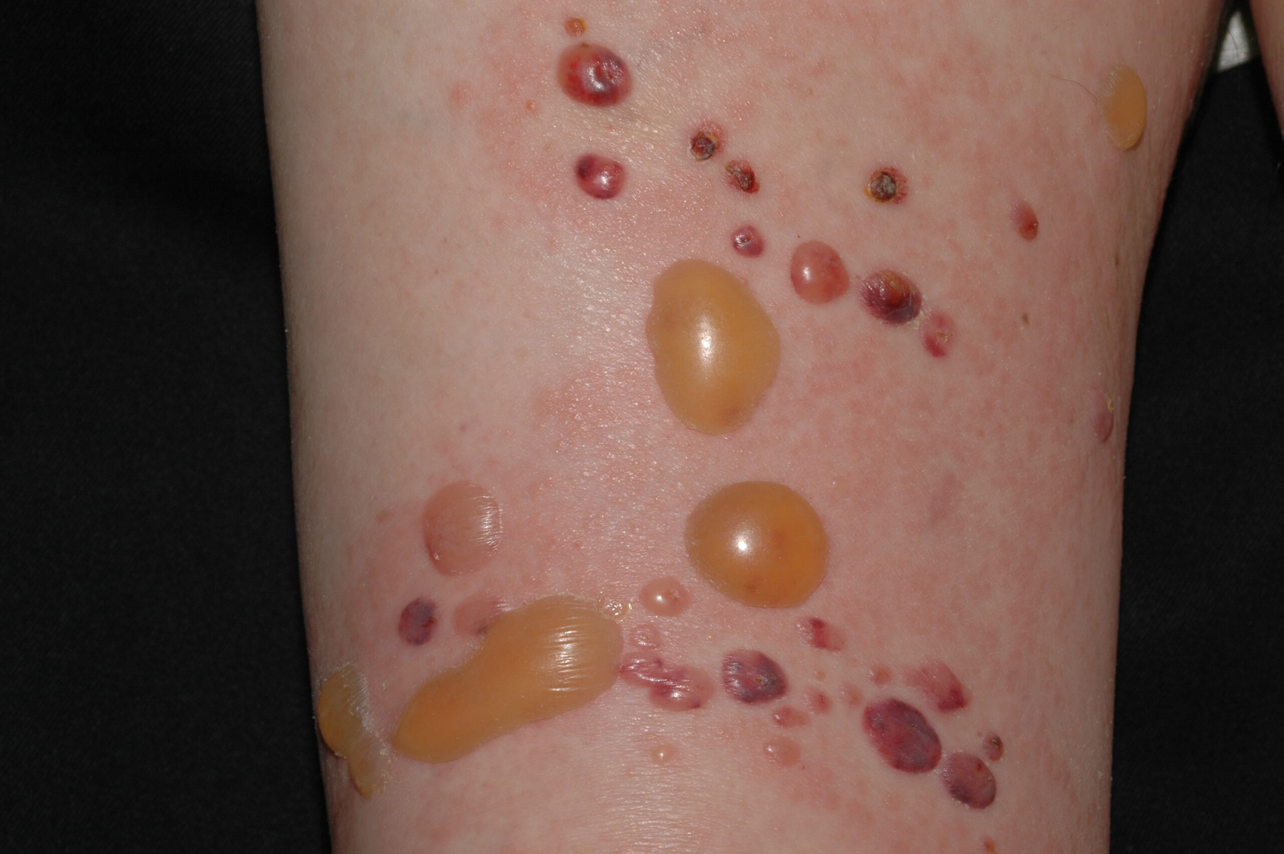 Penfigoide ampolloso L12; ampollas tensas sobre piel normal y sobre placas eritematosas en las piernas (3)