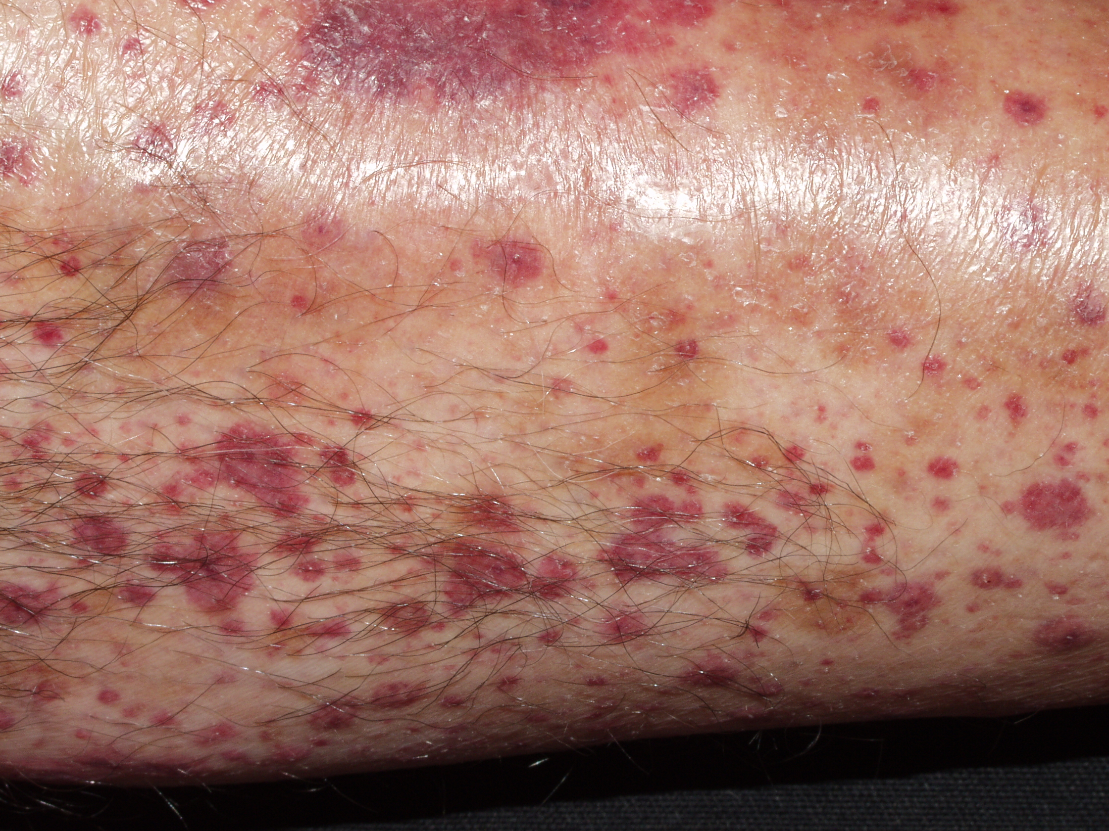 Vasculitis leucocitocl&aacute;stica