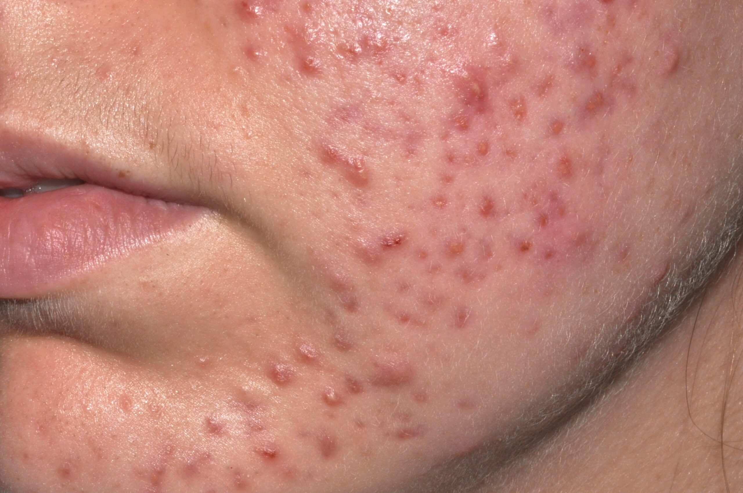 acne papulopustuloso severo L70.2; comedones, m&aacute;s de 30 p&aacute;pulop&uacute;stulas profundas y cicatrices (1)