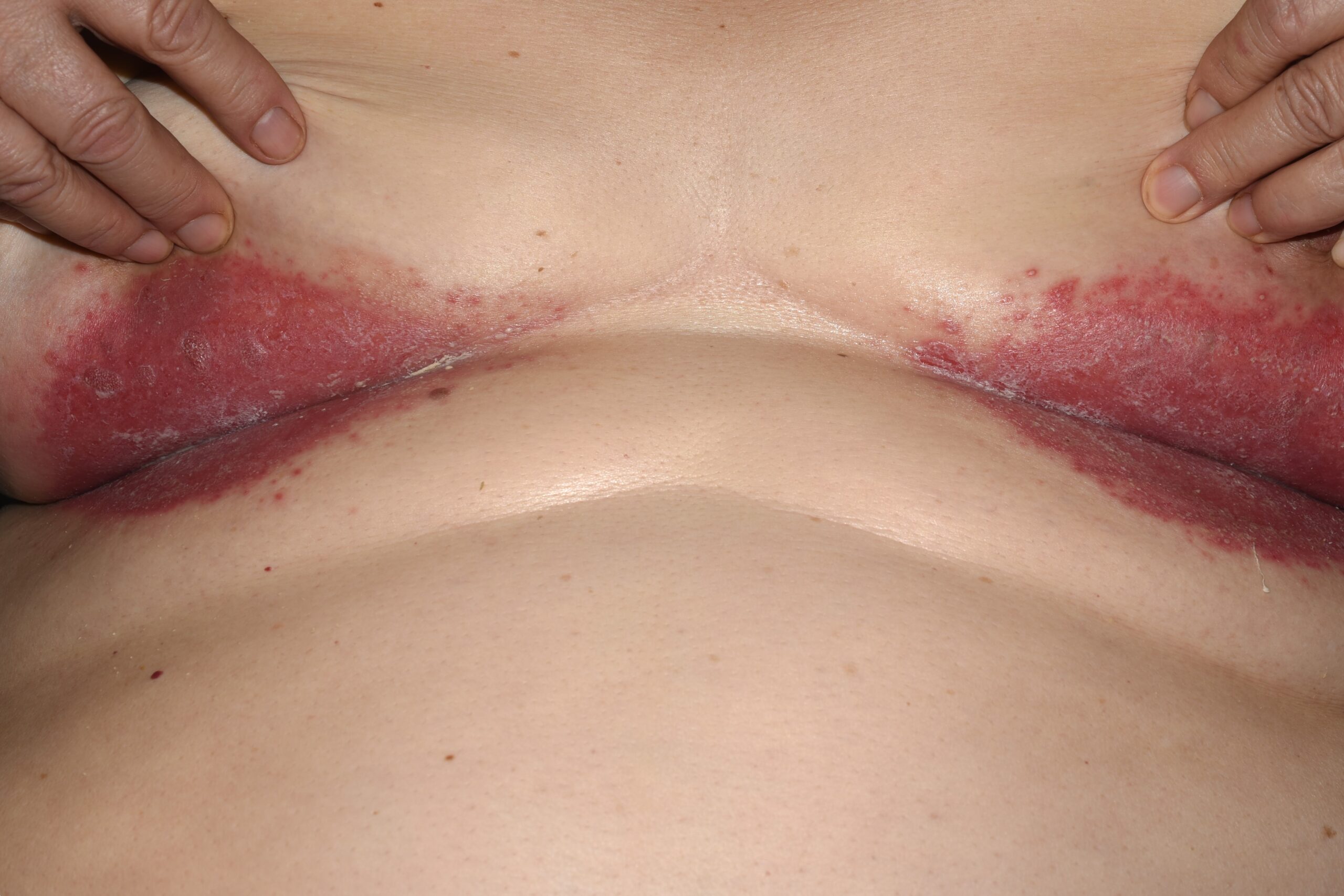 candidiasis (2)