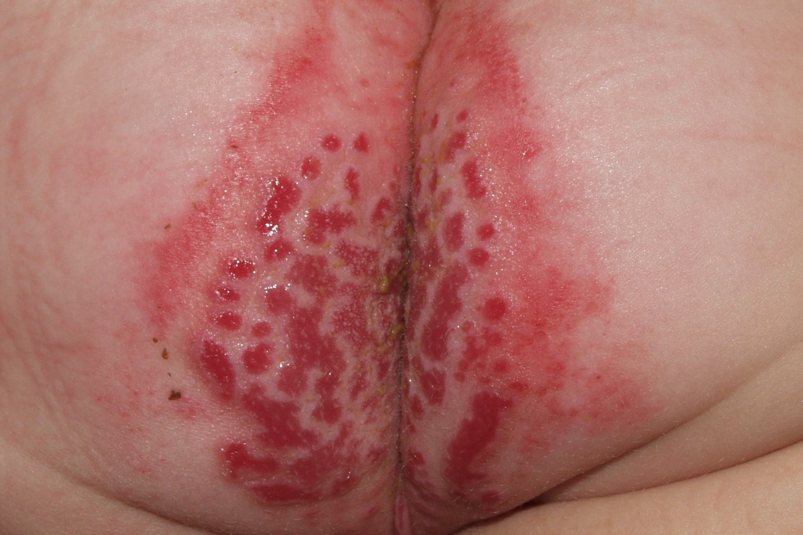 dermatitis irritativa de contacto L20.4; dermatitis del pañal erosiva (3)