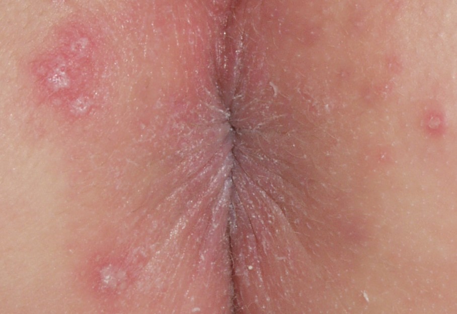 dermatitis irritativa de contacto L20.4; dermatitis del pañal erosiva
