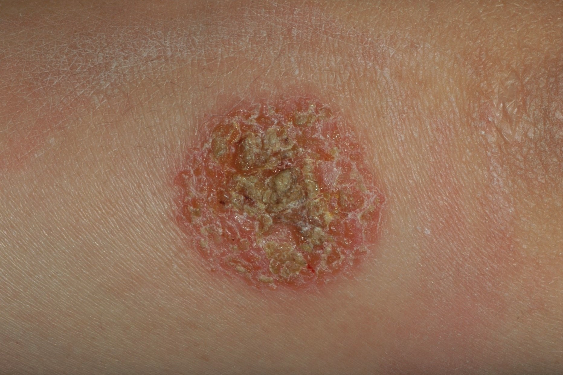 eczema numular D30; placa eritematosa con erosiones, exudación y escamocostras amarillentas en codo