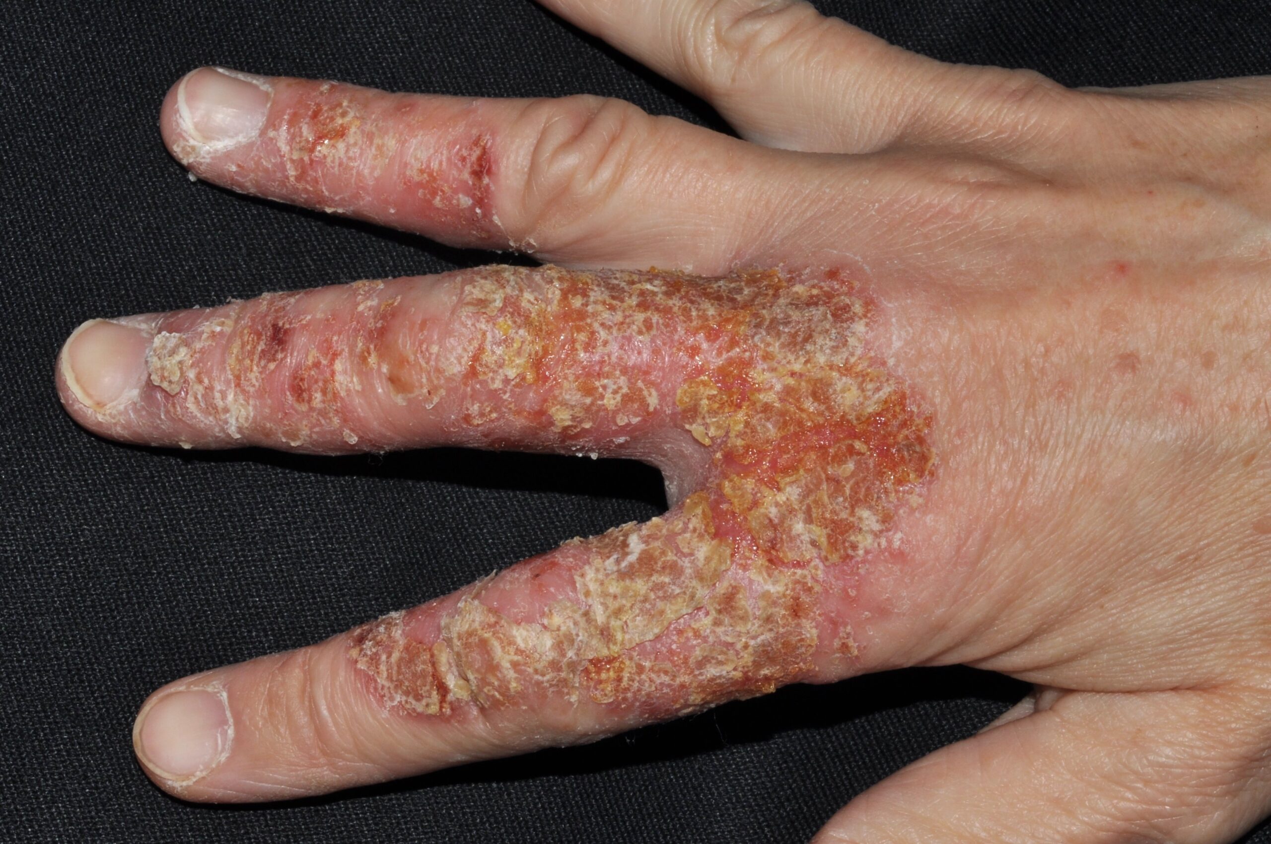eczema numular L30.0; placa eritematosa con erosiones, exudación y escamocostras amarillentas en dorso de manos (2)