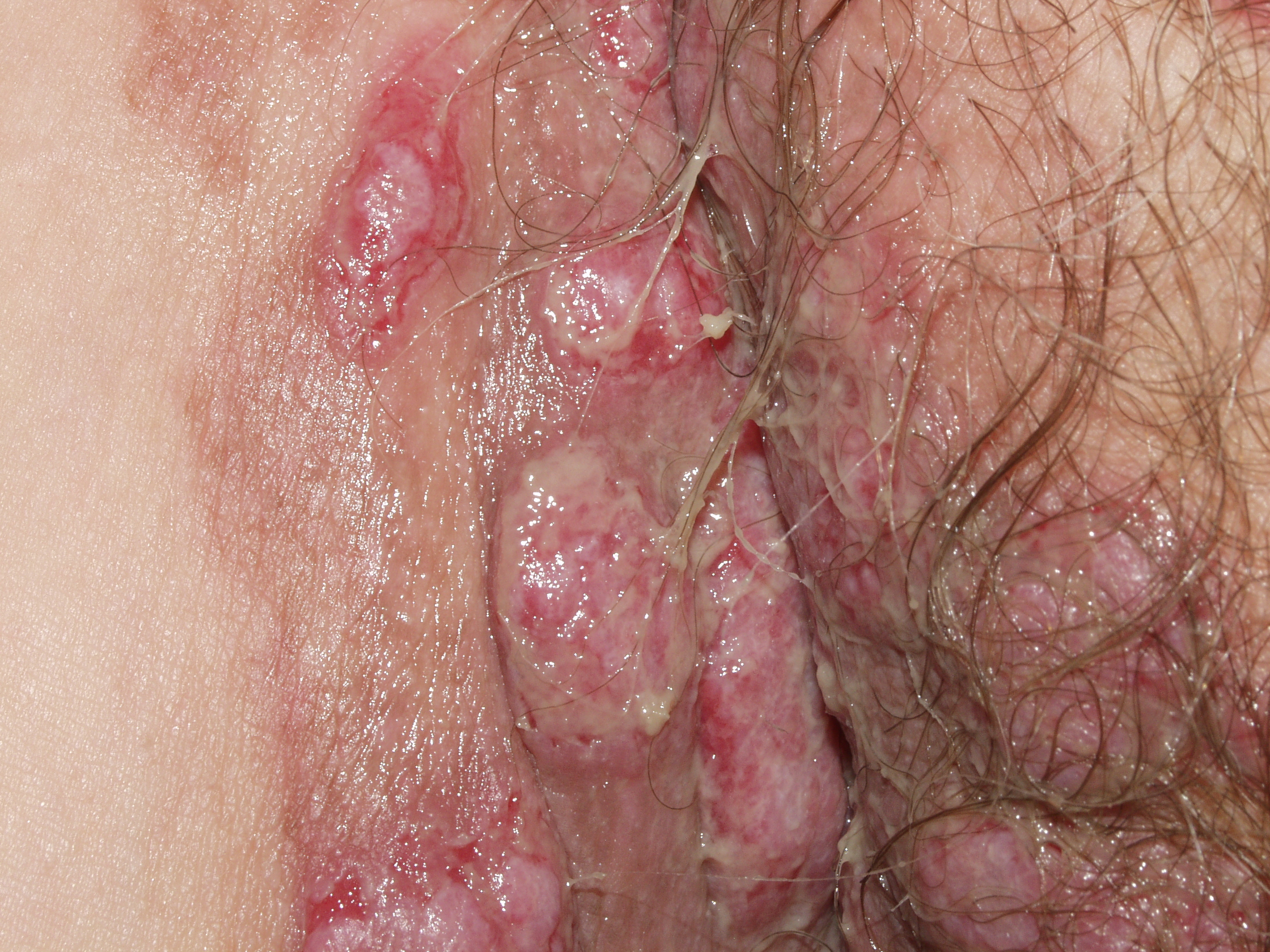 penfigo_vegetante0510_62169 (3)