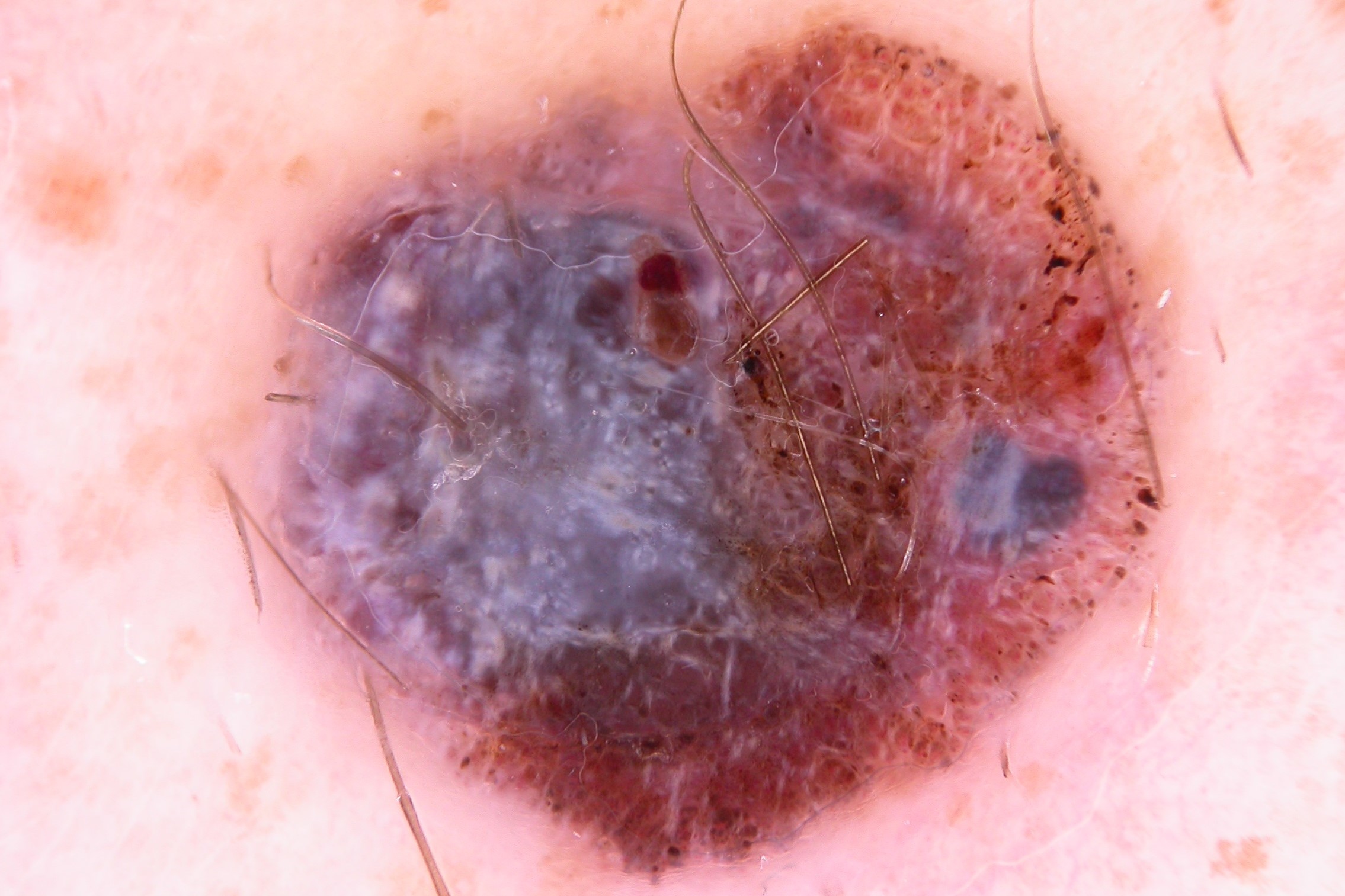 1Dermatoscopia MN; retículo invertido, velo azul-blanquecino, crisálidas, patrón vascular polimorfo, puntos y glóbulos pigmentados irregulares en periferia (1)