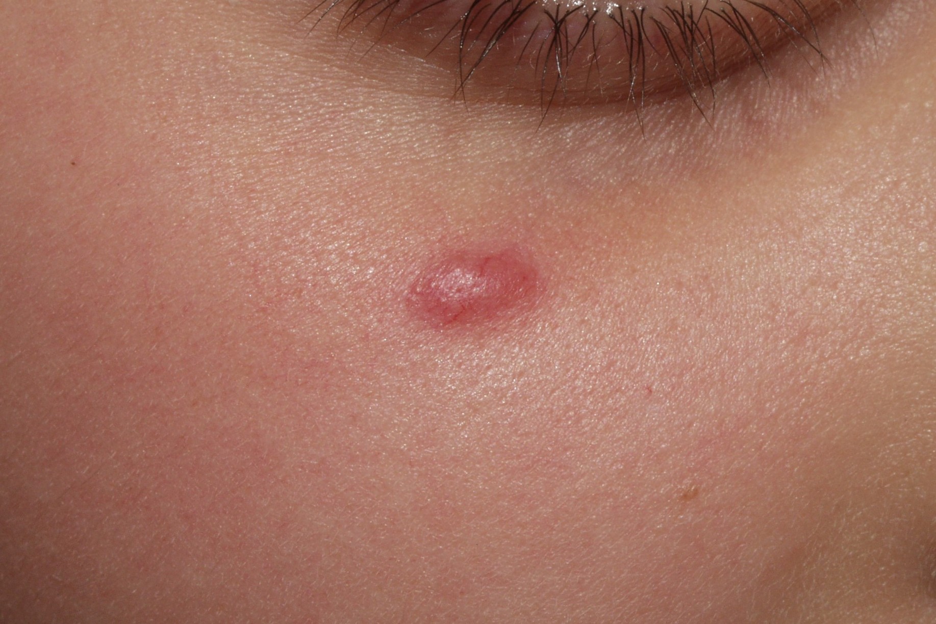 1Nevus de Spitz D20; pápula eritematosa semiesférica de 4 mm de diámetro que ha aumentado en los últimos meses