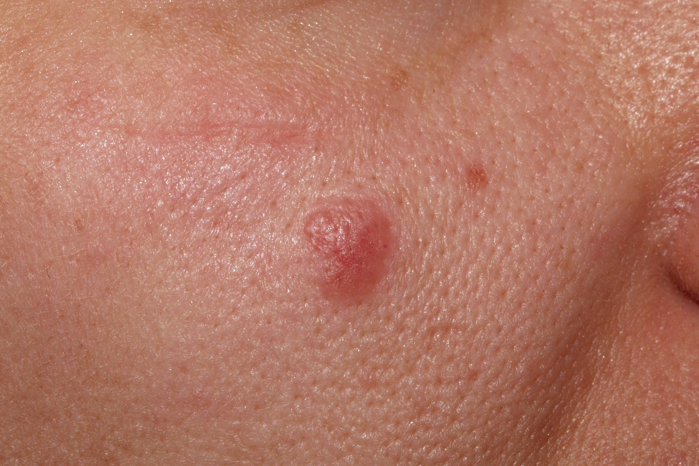 1Nevus de Spitz D20; pápula eritematosa semiesférica de 5 mm de diámetro que ha aumentado en los últimos 3 meses (1)