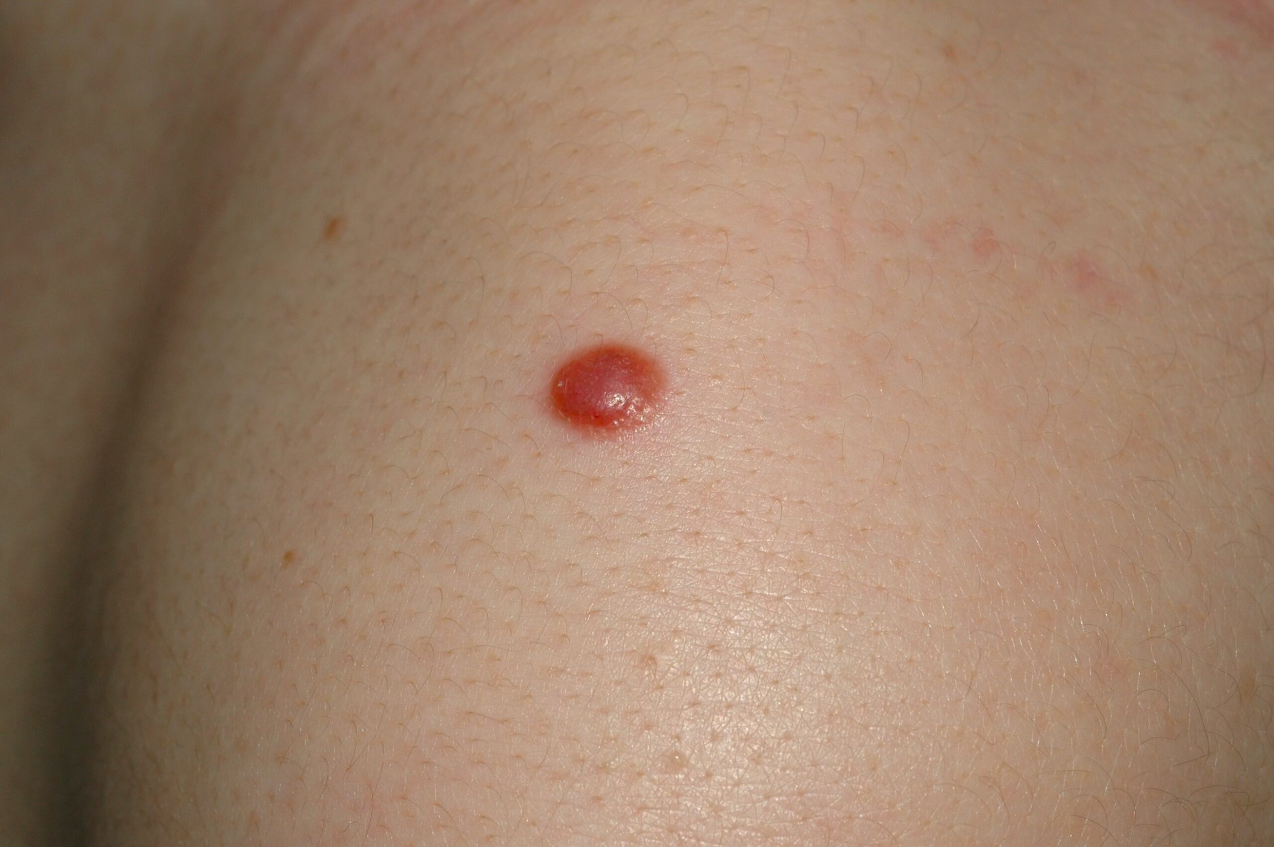 1Nevus de Spitz D20; pápula eritematosa semiesférica de 5 mm de diámetro que ha aumentado en los últimos 3 meses (3)
