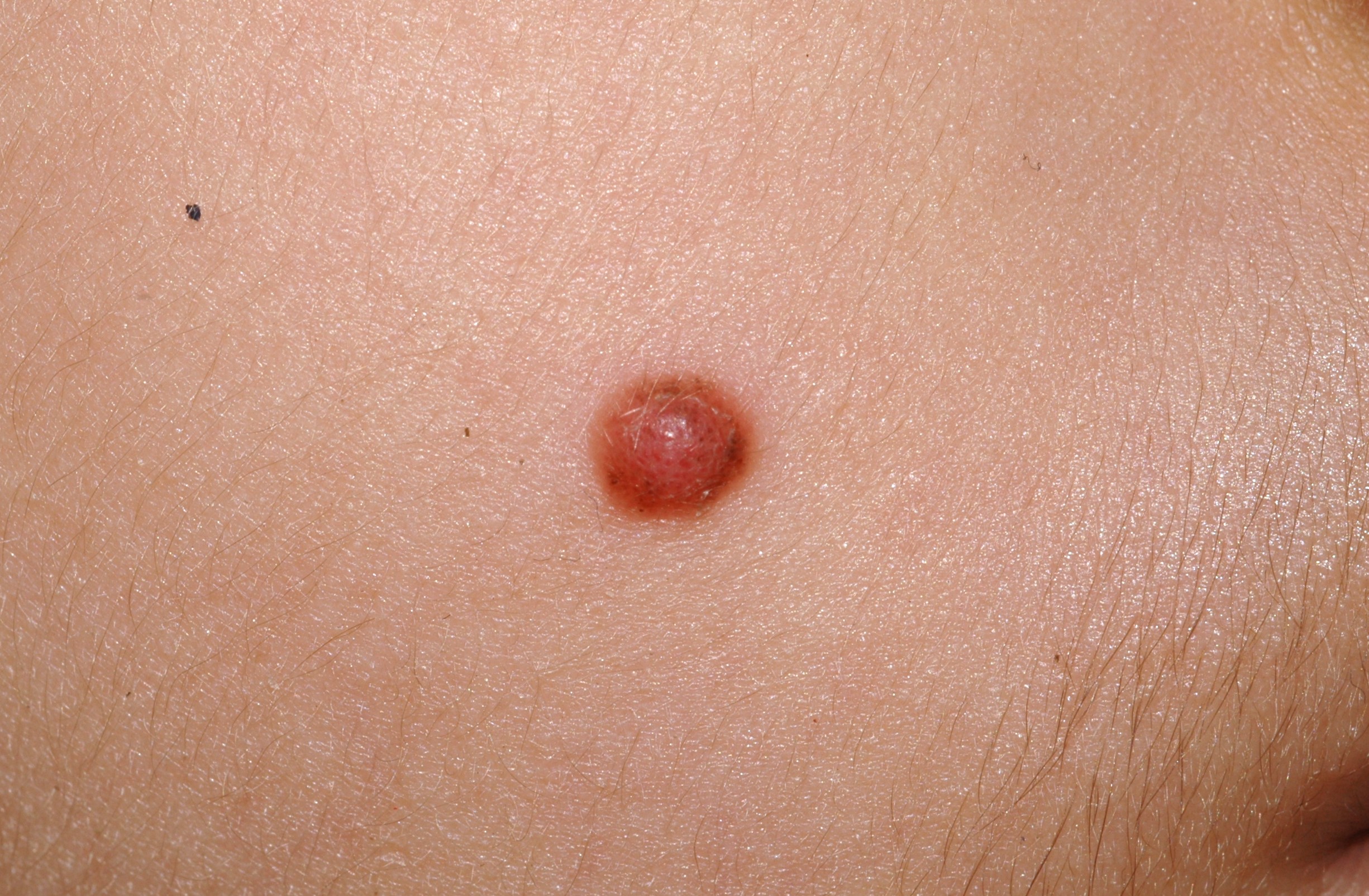 1Nevus de Spitz D20; pápula eritematosa semiesférica de 5 mm de diámetro que ha aumentado en los últimos 3 meses (4)