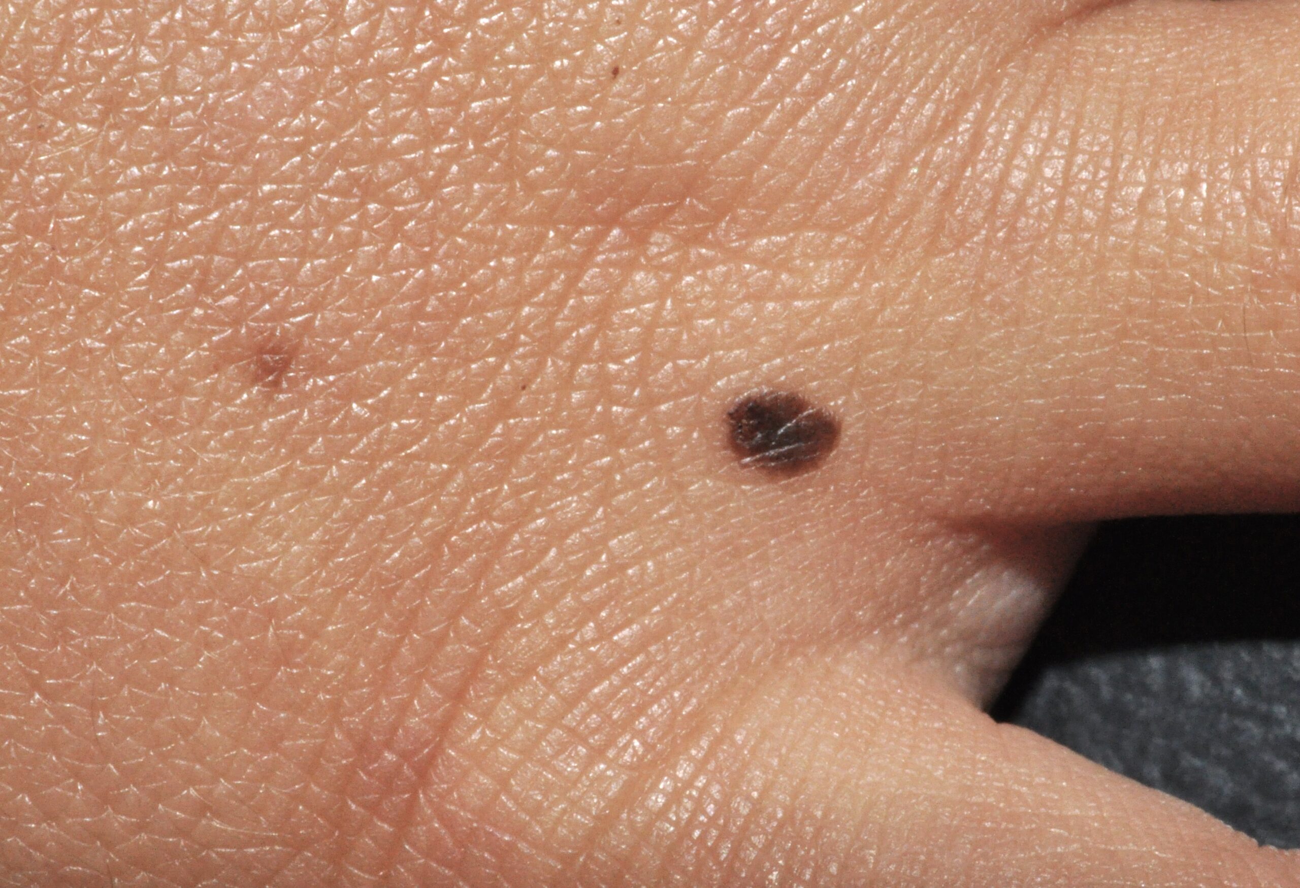 1Nevus de Spitz pigmentado D20; pápula hiperpigmentada aplanada de 3 mm de diámetro en un niño de 2 años1 (1)