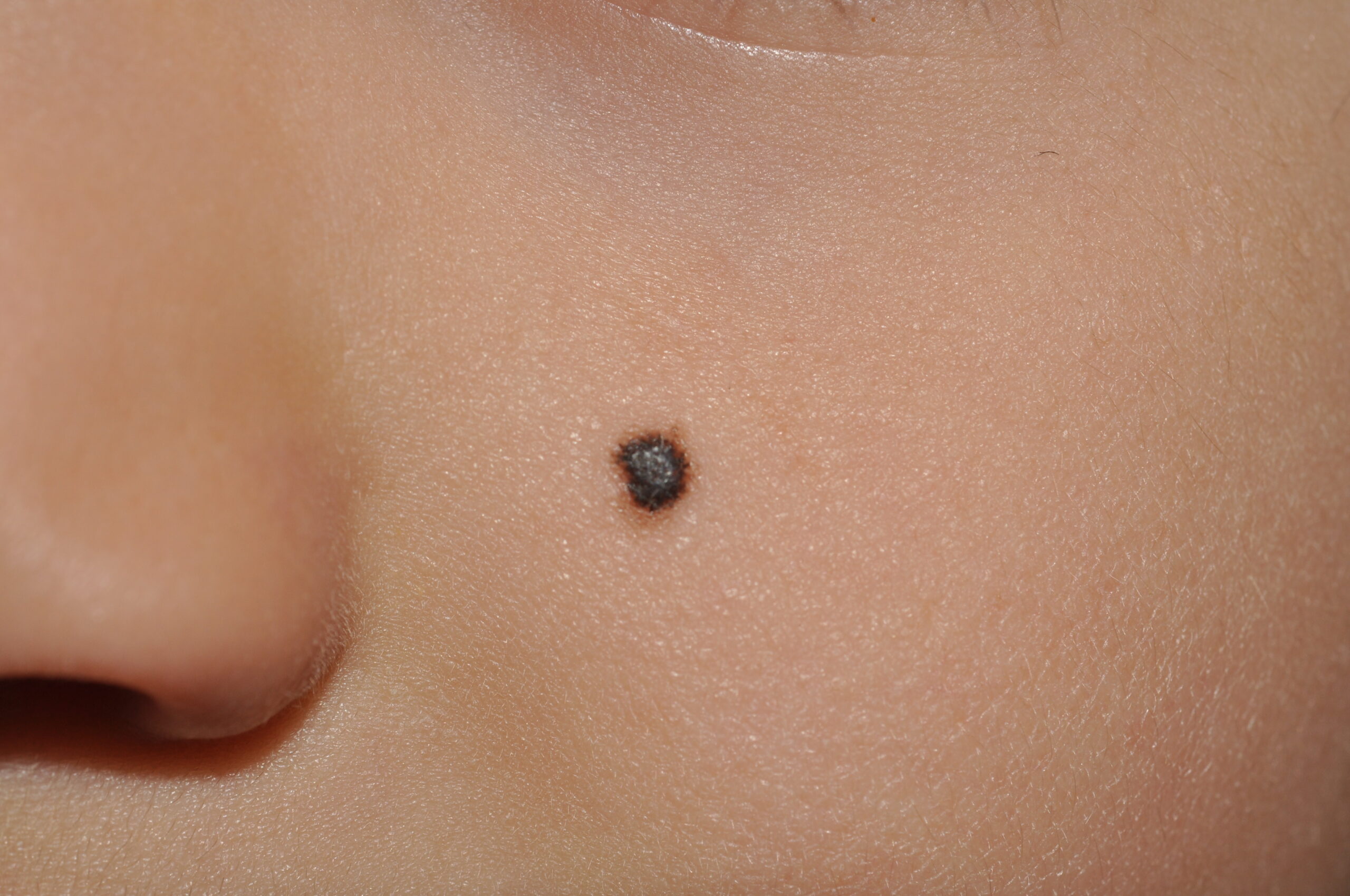 1Nevus de Spitz pigmentado D20; pápula hiperpigmentada aplanada de 3 mm de diámetro en un niño de 2 años1 (3)