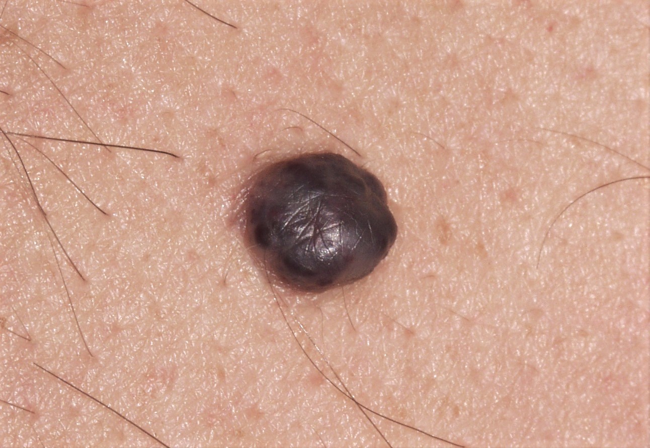 1melanoma nodular C43.9; nódulo negro-azulado de superficie lisa y mamelonada; diámetro 6 mm; localización pierna (1)