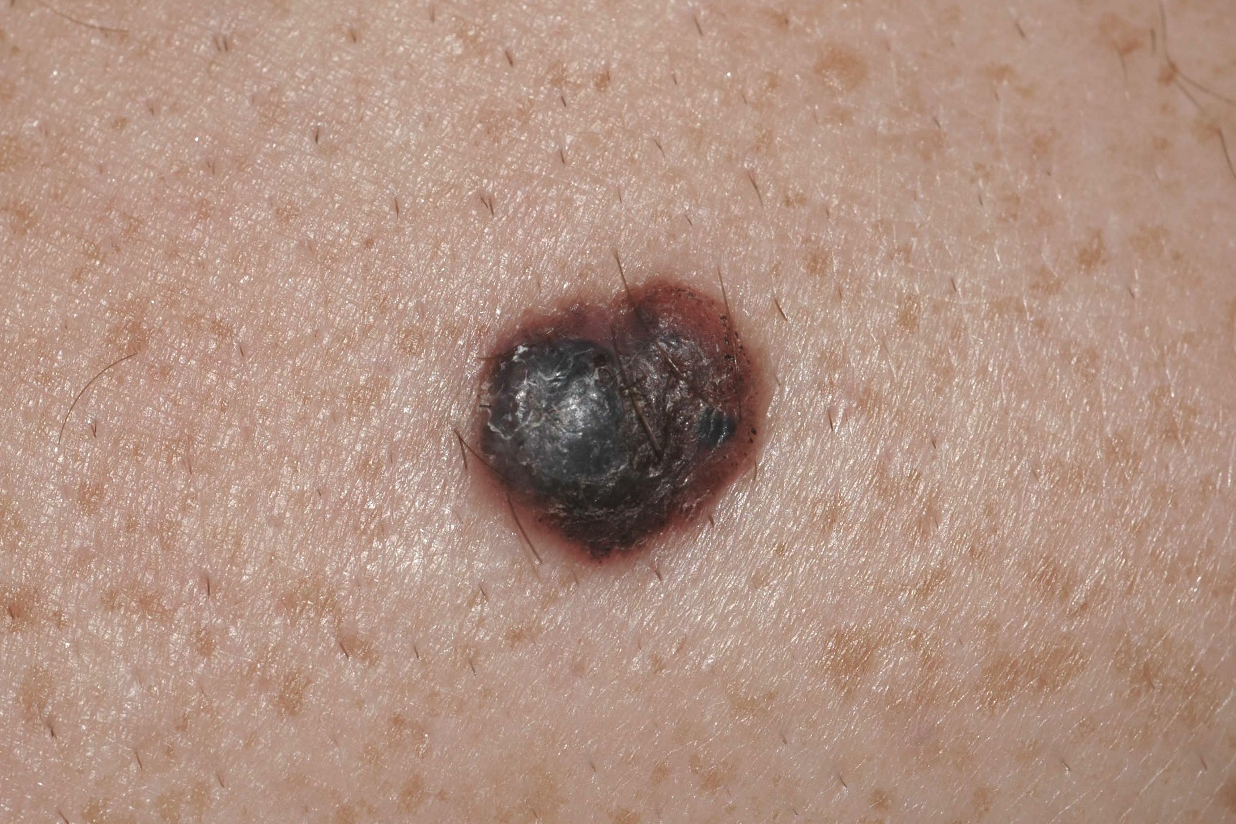 1melanoma nodular C43.9; nódulo negro-azulado de superficie lisa y mamelonada; diámetro 6 mm; localización pierna (3)