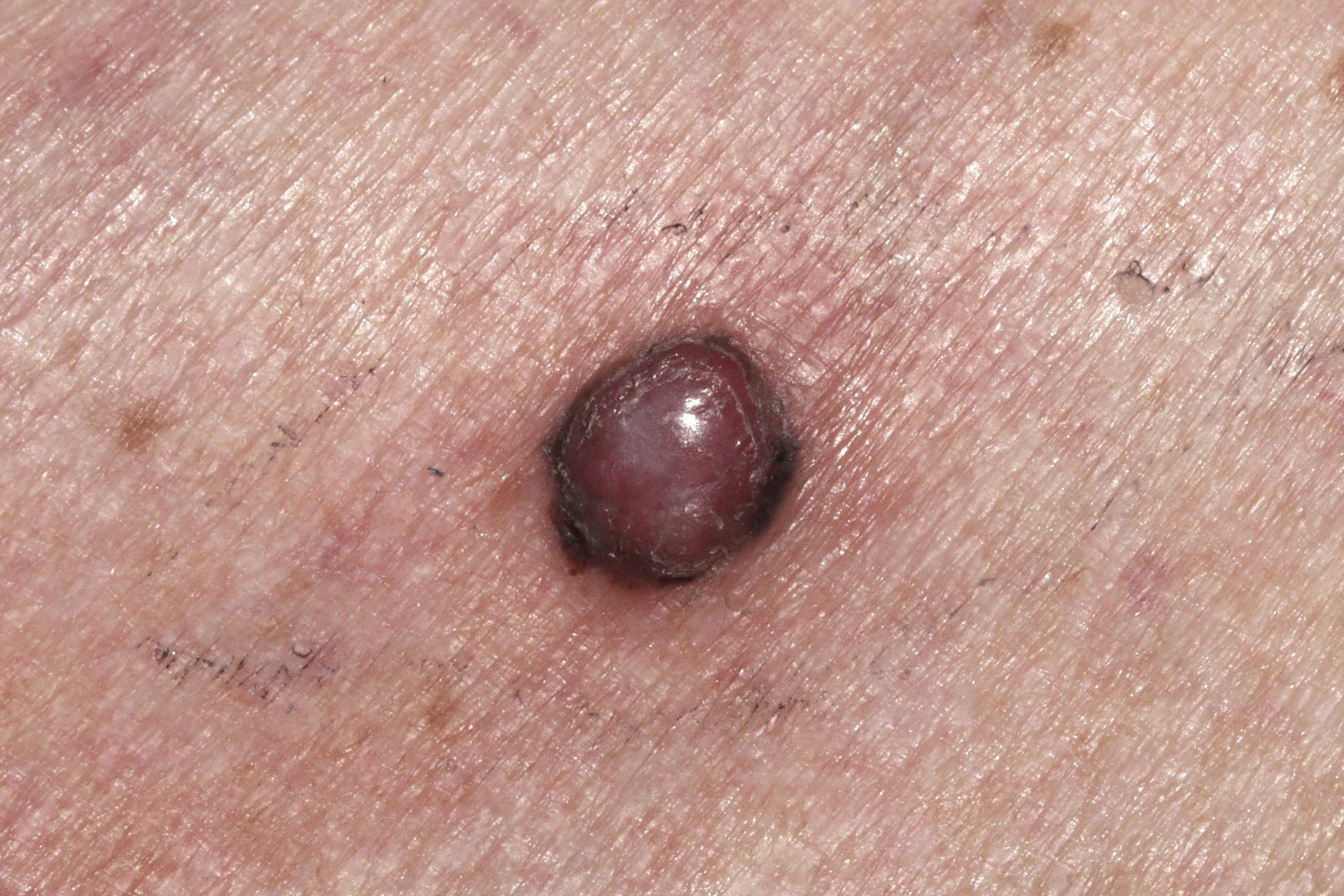1melanoma nodular C43.9; nódulo pigmentado en periferia de centro eritematoso; tamaño 9 mm; localización pierna; evaolución 6 meses (1)