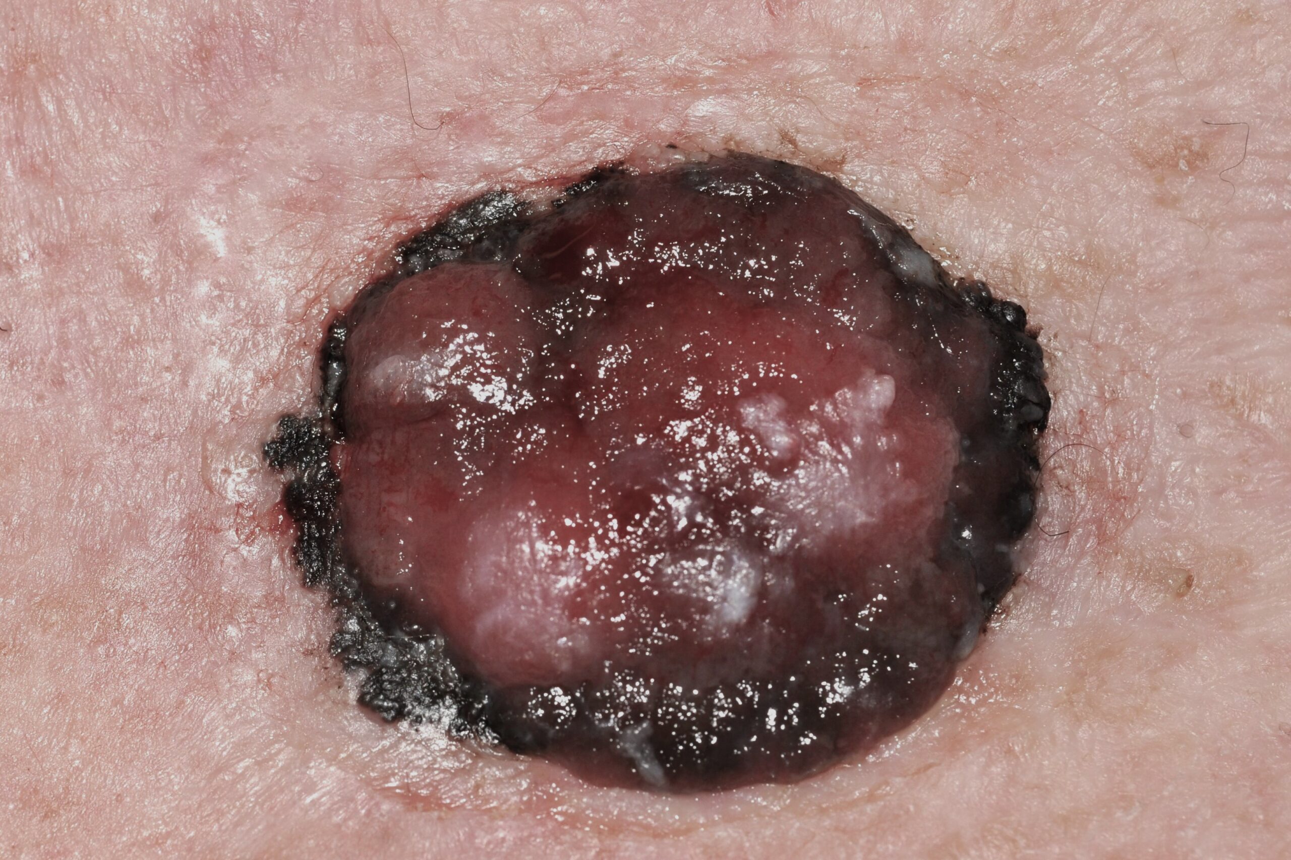 1melanoma nodular C43.9; nódulo pigmentado y ulcerado; tumor; 24 mm; localización pierna ; evolución 12 meses (2)