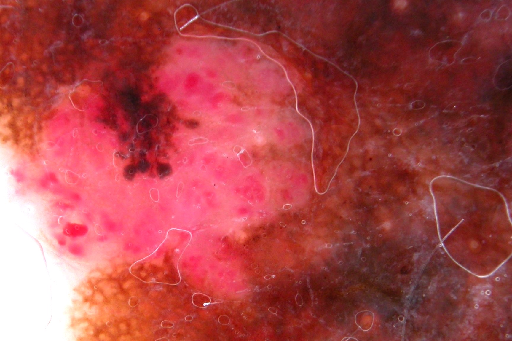 2MES, dermatoscopia; asimétrica eje v (en c y est) proyecciones en izq e inf, ret atipic area rojo-l, proyecciones (1)