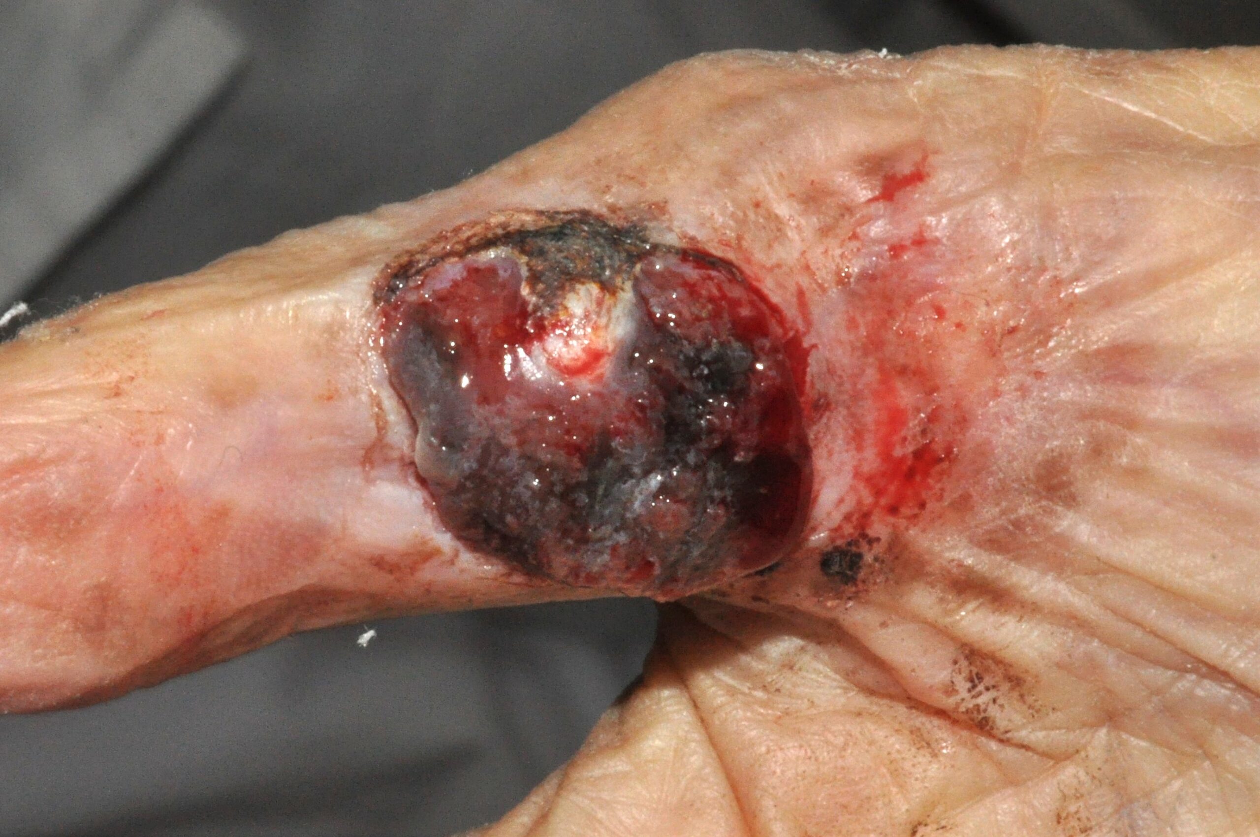 2Melanoma nodular C43.9; nóculo ulcerado y friable, de color negro-azulado, de 3x2 cm; localizado en la cara anterior del pulgar; evolución 2 años (1)