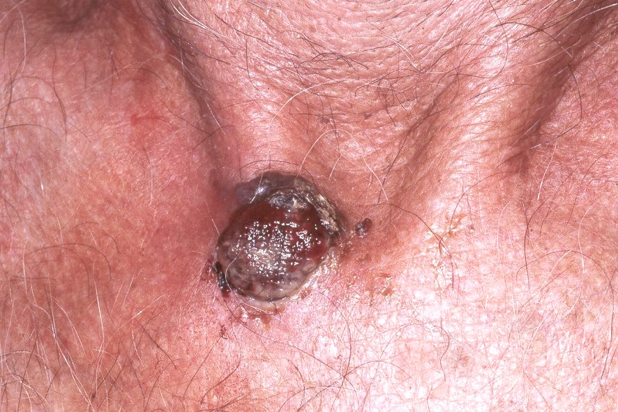 2melanoma nodular C43.9; nódulo negro-azulado, de centro ulcerado; diámetro 13 mm; localización base del cuello; evolución 2 años (1)