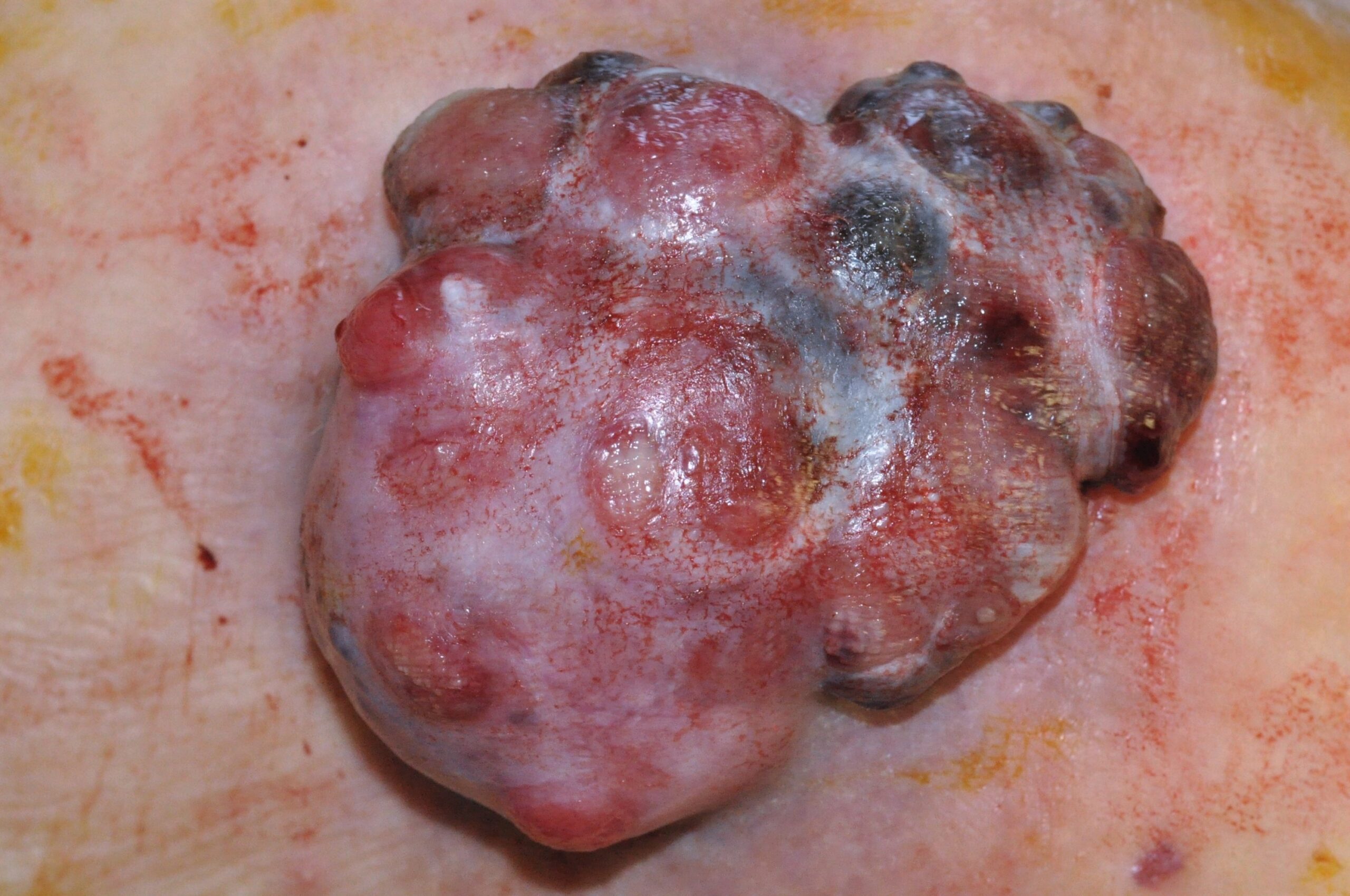 2melanoma nodular C43.9; tumor lobulado y exofítico, policromo, de centro eritematoso con zonas de color negro, de 8x6 cm; localización abdomen; evolución 3 años