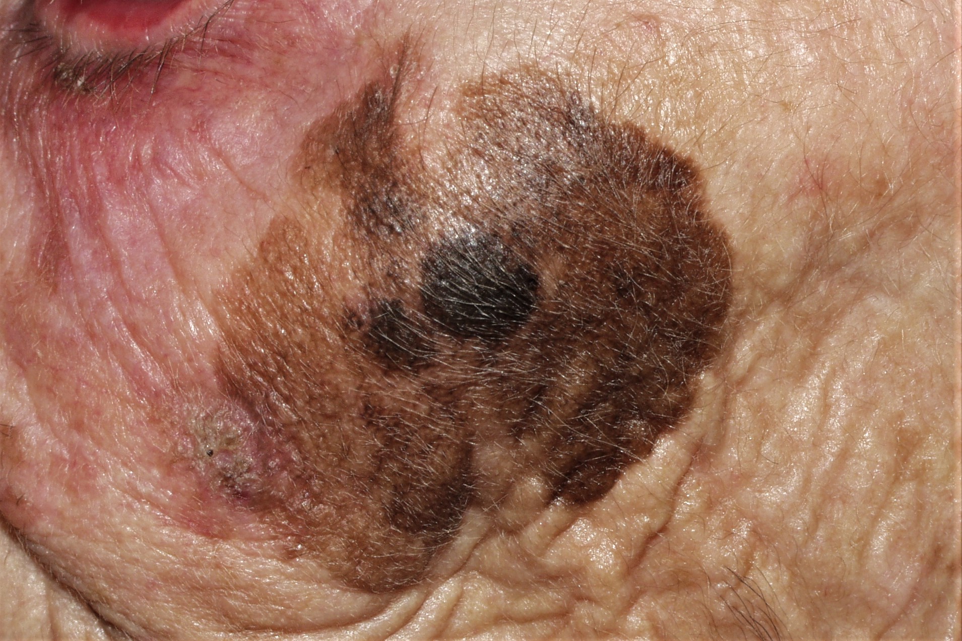 3Lentigo maligno melanoma C43; placa negra, brillante e irregular de 10 mm, sobre mácula de color marrón claro de 54x42 mm