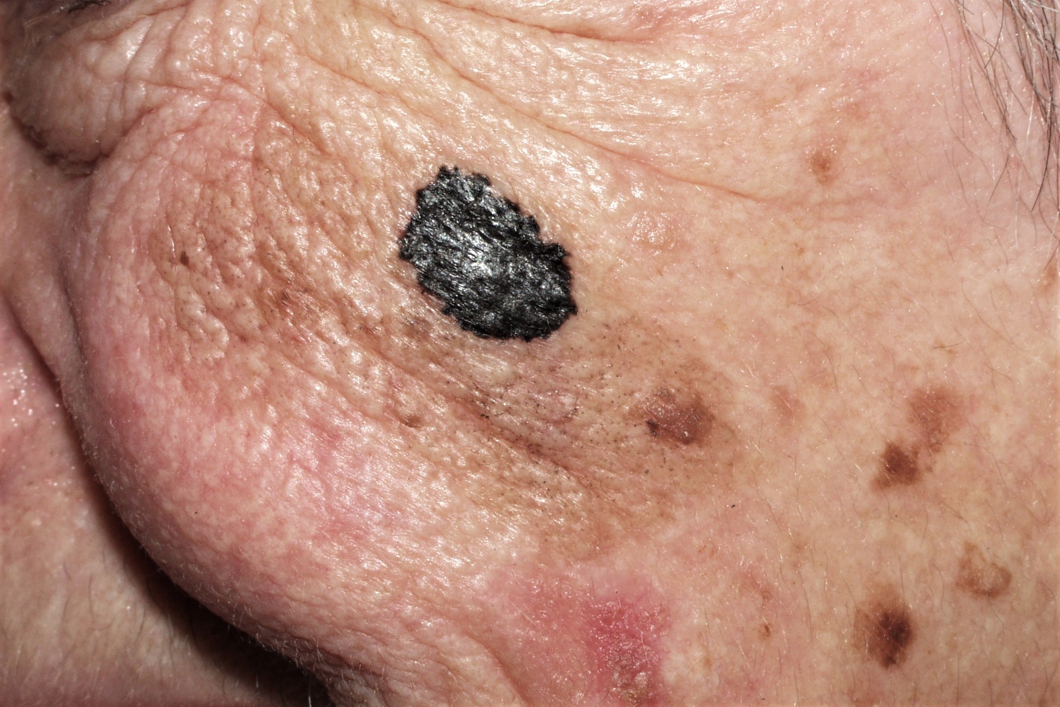 3Lentigo maligno melanoma C43; placa negra, brillante e irregular de 12 mm, sobre mácula de color marrón claro de 33 mm (1)