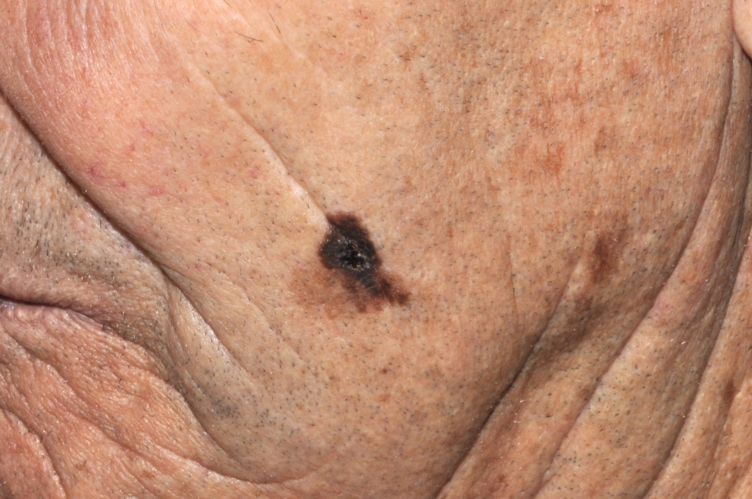 3Lentigo maligno melanoma C43; placa negra, brillante e irregular de 12 mm, sobre mácula de color marrón claro