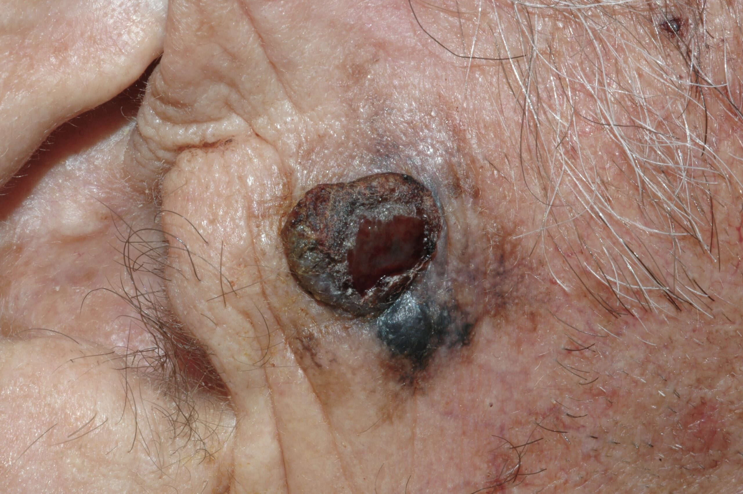 3Lentigo maligno melanoma C43.93; nódulo pigmentado y ulcerado sobre mácula policroma de bordes irregulares; preauricular