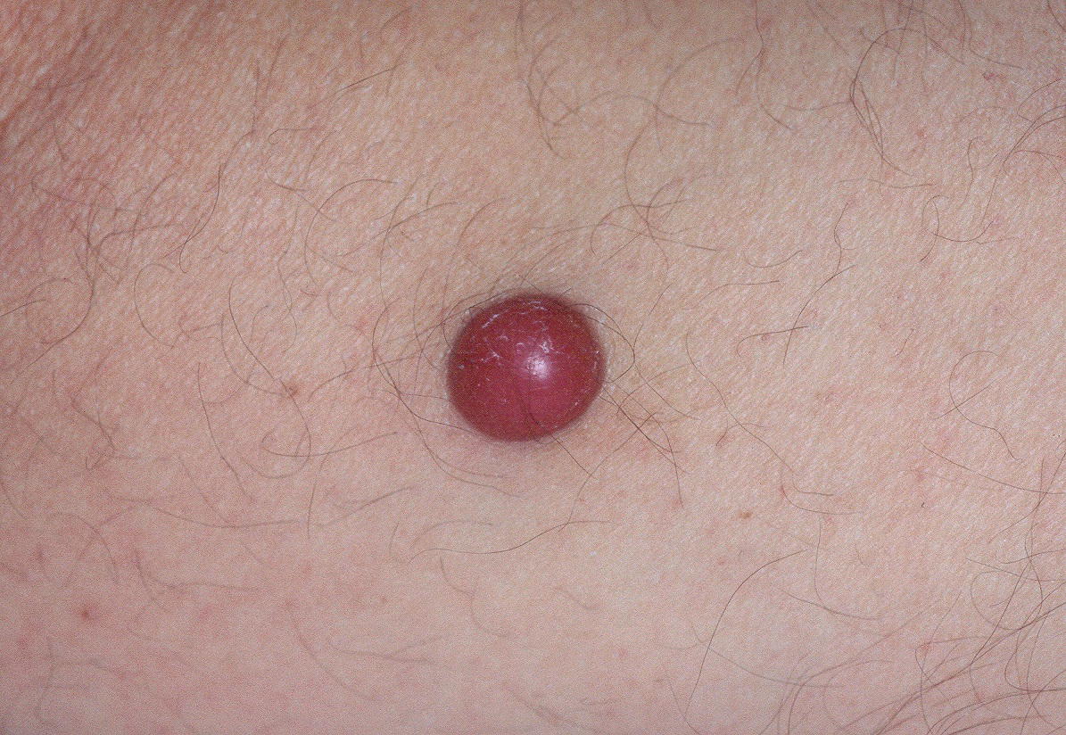 3Melanoma nodular amelanótico C43.9; nódulo eritematoso de superficie lisa; tamaño 9 mm; localización pierna; evolución 9 meses