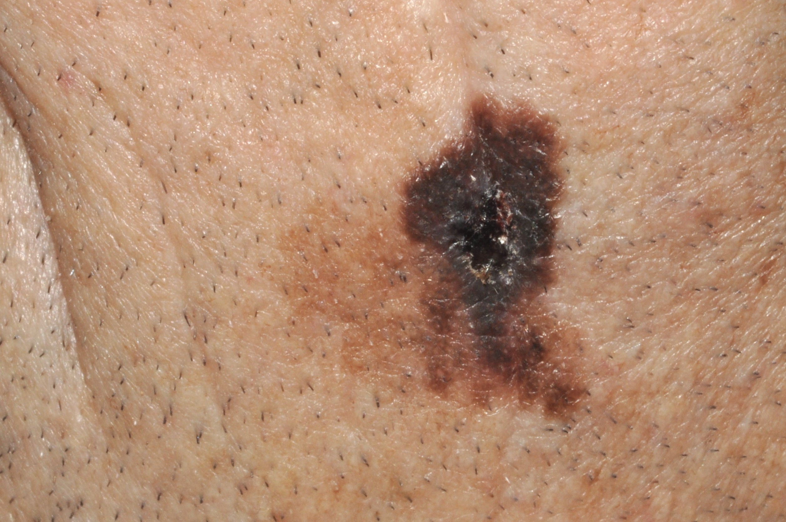 3Melanoma sobre léntigo maligno C43; placa negra, brillante e irregular de 22 mm, sobre mácula de color marrón claro